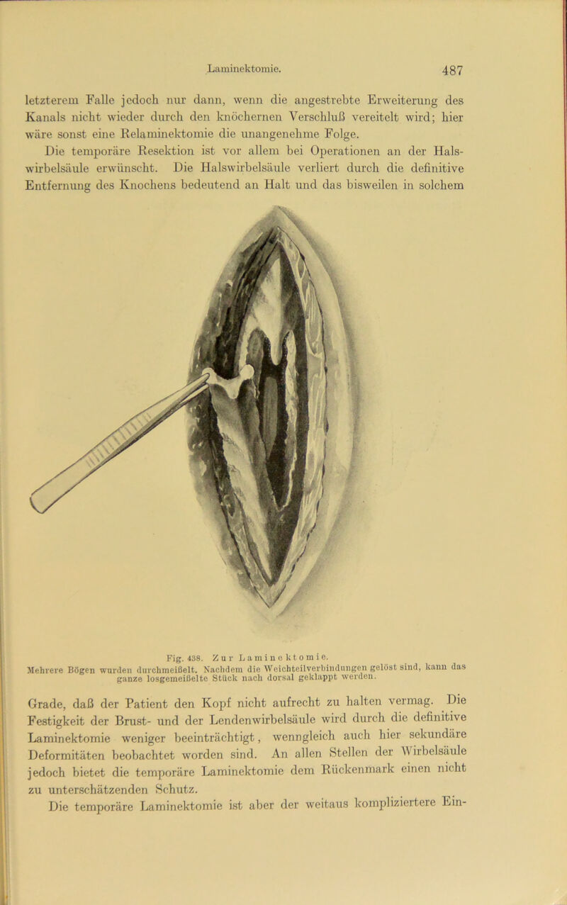 Fig. 438. Zur Laminektornie. Mehrere Bögen wurden durchmeißelt. Nachdem die Weichteilverbiiidiiiigen gelüst sind, kann das ganze losgemeißelte StUck nach dorsal geklappt werden. Grade, daß der Patient den Kopf nicht aufrecht zu halten vermag. Die Festigkeit der Brust- und der Lendenwirbelsäule wird durch die definitive Laminektomie weniger beeinträchtigt, wenngleich auch hier sekundäre Deformitäten beobachtet worden sind. An allen Stellen der Wirbelsäule jedoch bietet die temporäre Laminektomie dem Rückenmark einen nicht zu unterschätzenden Schutz. Die temporäre Laminektomie ist aber der weitaus kompliziertere Ein- letzterem Falle jedoch nur dann, wenn die angestrebte Erweiterung des Kanals nicht wieder durch den knöchernen Verschluß vereitelt wird; hier wäre sonst eine Relaminektomie die unangenehme Folge. Die temporäre Resektion ist vor allem bei Operationen an der Hals- wirbelsäule erwünscht. Die Halswirbelsäule verliert durch die definitive Entfernung des Knochens bedeutend an Halt und das bisweilen in solchem