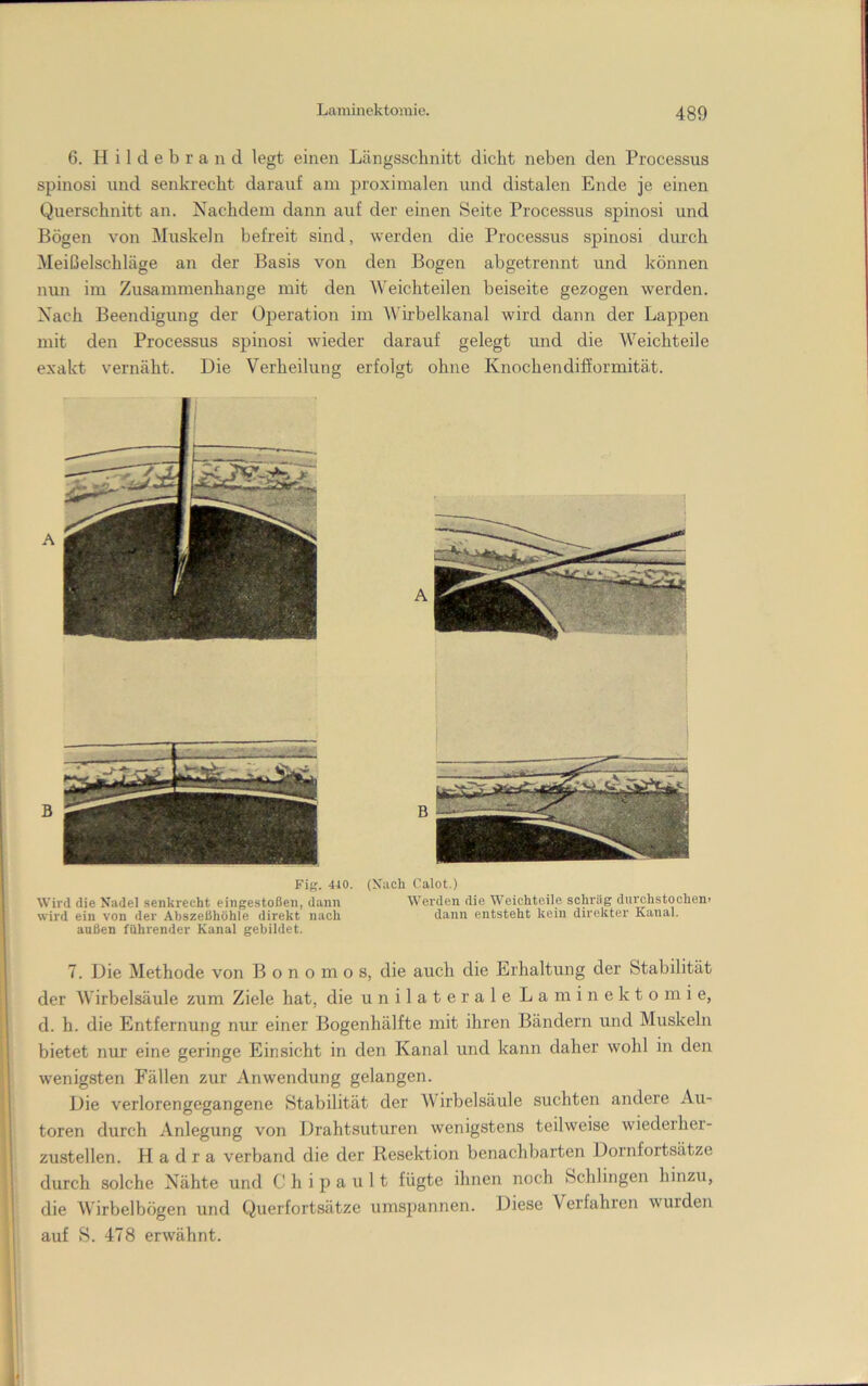 6. H i 1 d e b r a n d legt einen Längsschnitt dicht neben den Processus spinosi und senkrecht darauf am proximalen und distalen Ende je einen Querschnitt an. Nachdem dann auf der einen Seite Processus spinosi und Bögen von Muskeln befreit sind, werden die Processus spinosi durch Meißelschläge an der Basis von den Bogen abgetrennt und können mm im Zusammenhänge mit den Weichteilen beiseite gezogen werden. Nach Beendigung der Operation im Wirbelkanal wird dann der Lappen mit den Processus spinosi wieder darauf gelegt und die Weichteile exakt vernäht. Die Verheilung erfolgt ohne Knochendifformität. Fig. 410. (Xach Calot.) Wird die Nadel senkrecht eingestoßen, dann Werden die Weichteile schräg durchstochen’ wird ein von der Abszeßhöhle direkt nach dann entsteht kein direkter Kanal, außen führender Kanal gebildet. 7. Die Methode von B o n o m o s, die auch die Erhaltung der Stabilität der Wirbelsäule zum Ziele hat, die unilaterale Laniinektomie, d. h. die Entfernung nur einer Bogenhälfte mit ihren Bändern und Muskeln bietet nur eine geringe Einsicht in den Kanal und kann daher wohl in den wenigsten Fällen zur Anwendung gelangen. Die verlorengegangene Stabilität der Wirbelsäule suchten andere Au- toren durch Anlegung von Drahtsuturen wenigstens teilweise wiederher- zustellen. H a d r a verband die der Resektion benachbarten Dornfortsätze durch solche Nähte und C h i p a u 11 fügte ihnen noch Schlingen hinzu, die Wirbelbögen und Querfortsätze umspannen. Diese Verfahren wurden auf S. 478 erwähnt.