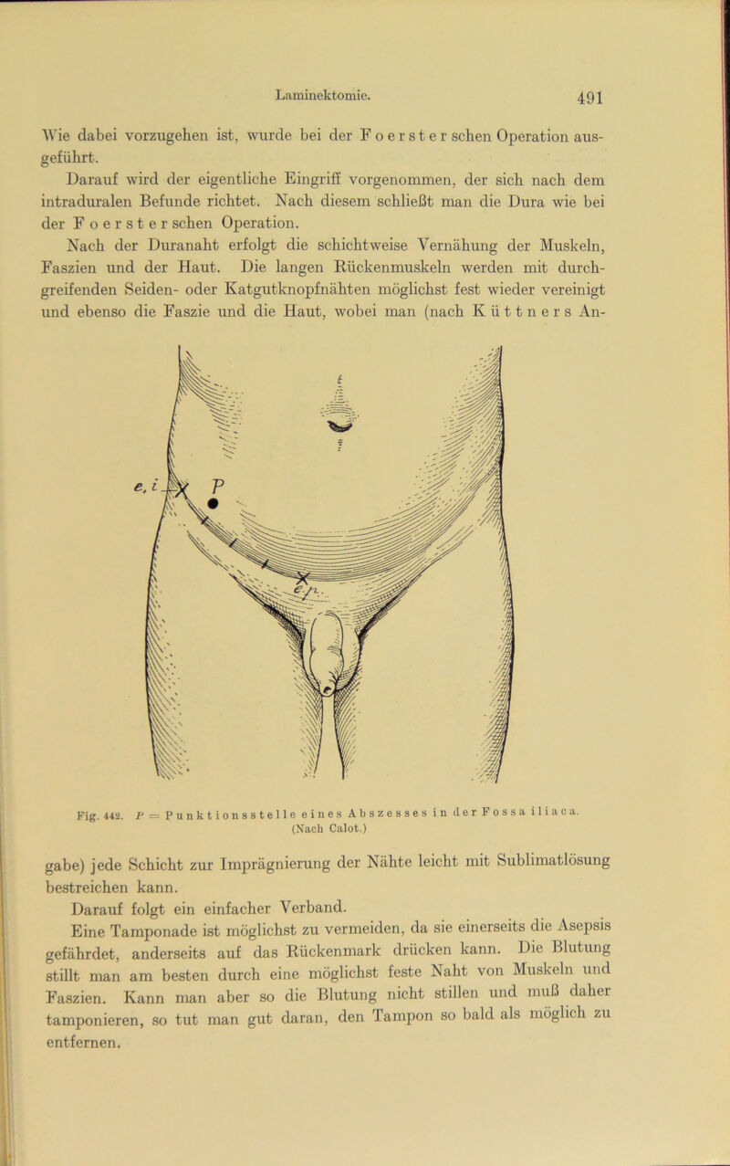 Wie dabei vorzugehen ist, wurde bei der Foerster sehen Operation aus- geführt. Darauf whd der eigentliche EingrijS vorgenommen, der sich nach dem intraduralen Befunde richtet. Nach diesem schließt man die Dura wie bei der Foerster sehen Operation. Nach der Dm’anaht erfolgt die schichtweise Vernähung der Muskeln, Faszien und der Haut. Die langen Rückenmuskeln werden mit durch- greifenden Seiden- oder Katgutknopfnähten möglichst fest wieder vereinigt und ebenso die Faszie imd die Haut, wobei man (nach K ü 11 n e r s An- Fig. 442. F = Punktionsstelle eines Abszesses in der Fossa iliaca. (Nach Calot.) gäbe) jede Schicht zur Imprägnierung der Nähte leicht mit Sublimatlösung bestreichen kann. Darauf folgt ein einfacher Verband. Eine Tamponade ist möglichst zu vermeiden, da sie einerseits die Asepsis gefährdet, anderseits auf das Rückenmark drücken kann. Die Blutung stillt man am besten durch eine möglichst feste Naht von Muskeln und Faszien. Kann man aber so die Blutung nicht stillen und muß daher tamponieren, so tut man gut daran, den Tampon so bald als möglich zu entfernen.