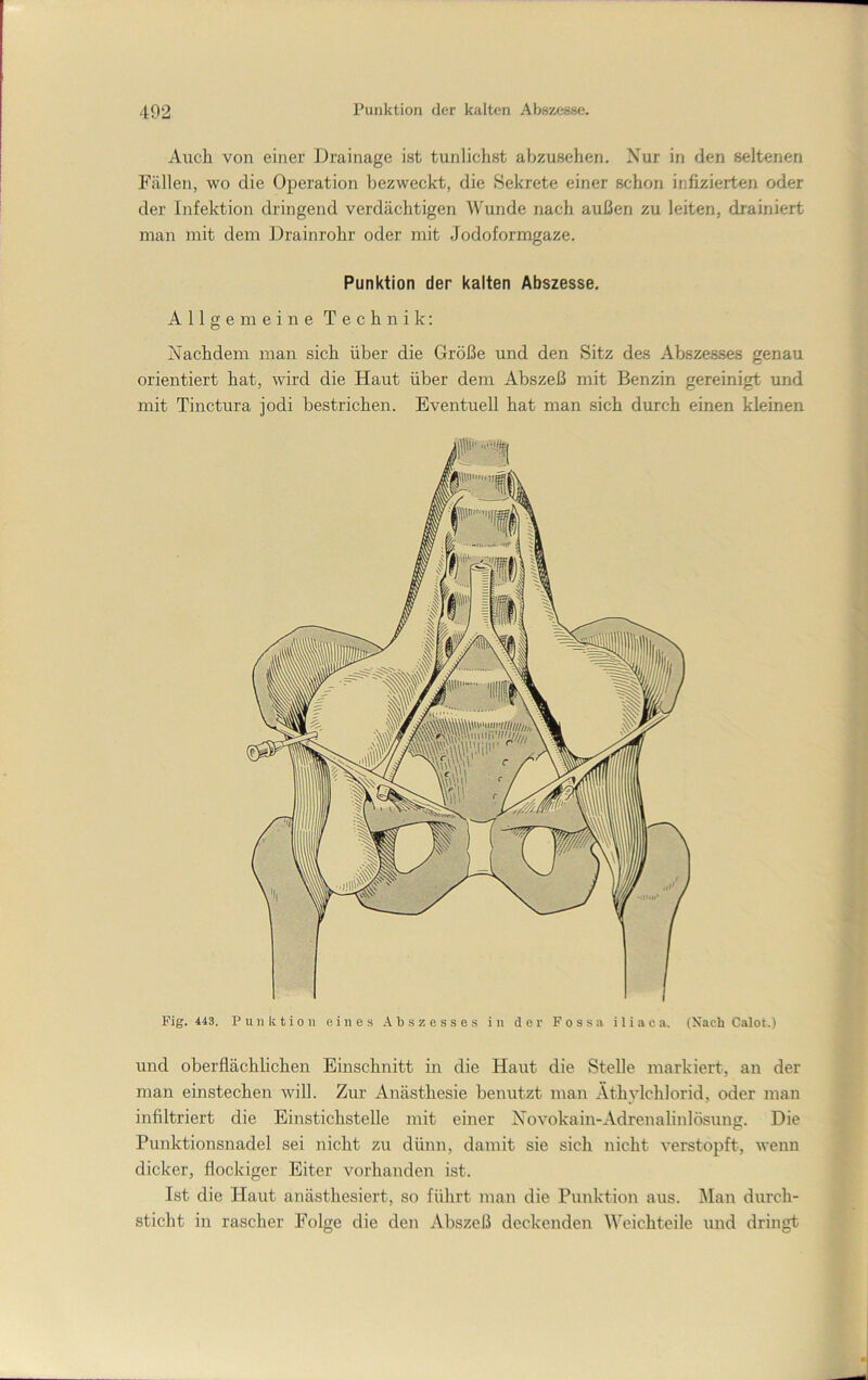 Aiich von einer Drainage ist tunlichst abzusehen. Nur in den seltenen Fällen, wo die Operation bezweckt, die Sekrete einer schon infizierten oder der Infektion dringend verdächtigen Wunde nach außen zu leiten, drainiert man mit dem Drainrohr oder mit Jodoformgaze. Punktion der kalten Abszesse. Allgemeine Technik: Nachdem man sich über die Größe und den Sitz des Abszesses genau orientiert hat, wird die Haut über dem Abszeß mit Benzin gereinigt und mit Tinctura jodi bestrichen. Eventuell hat man sich durch einen kleinen Fig. 443. Punktion eines Abszesses in der F o s s a i 1 i a c a. (Nach Calot.) und oberflächlichen Einschnitt in die Haut die Stelle markiert, an der man einstechen will. Zur Anästhesie benutzt man Äthvlchlorid, oder man infiltriert die Einstichstelle mit einer Novokain-Adrenalinlösung. Die Punktionsnadel sei nicht zu dünn, damit sie sich nicht verstopft, wenn dicker, flockiger Eiter vorhanden ist. Ist die Haut anästhesiert, so führt man die Punktion aus. Man durch- sticht in rascher Folge die den Abszeß deckenden Weichteile und dringt