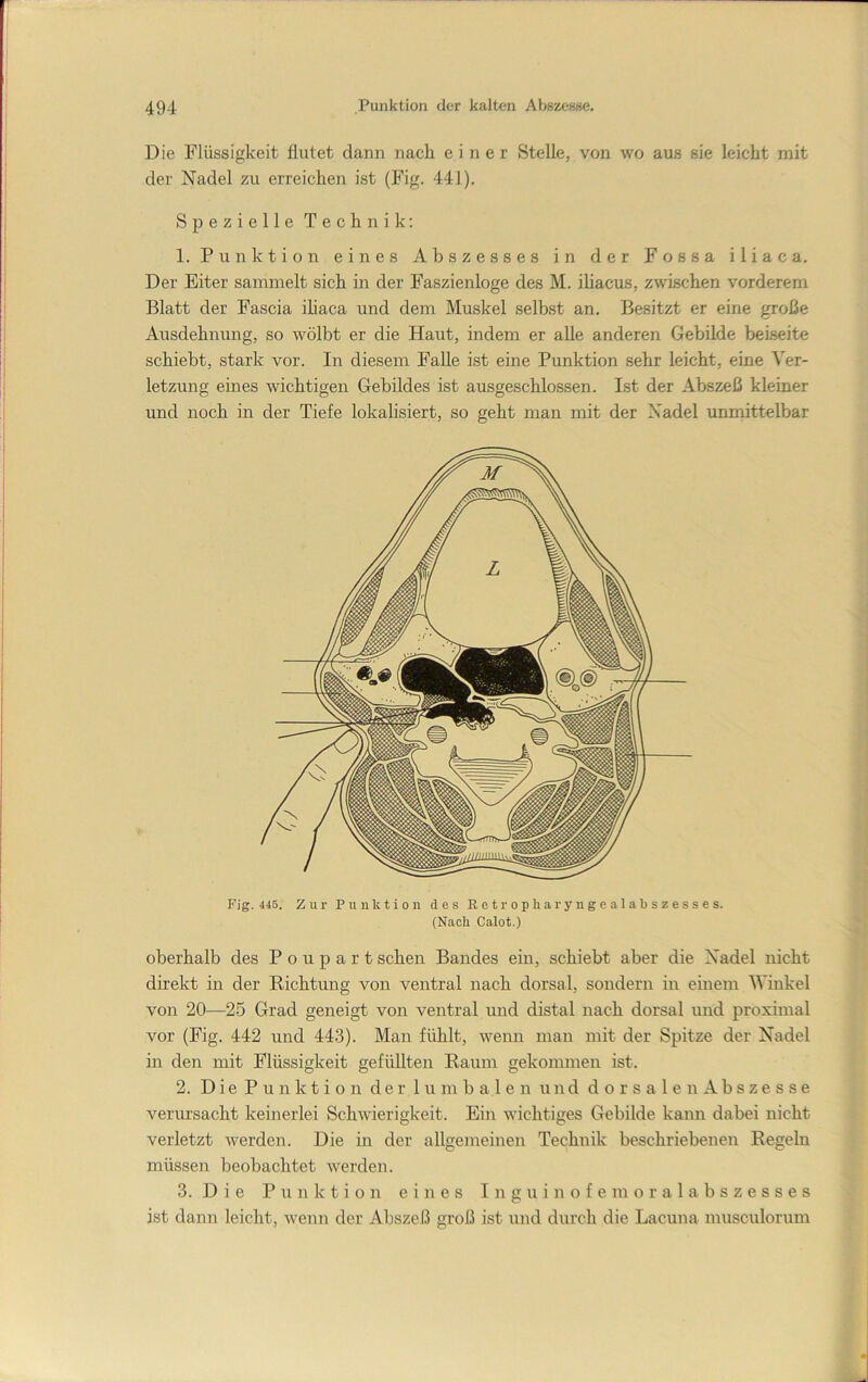 Die Flüssigkeit flutet dann nach einer Stelle, von wo aus sie leicht mit der Nadel zu erreichen ist (Fig. 441). Spezielle Technik; 1. Punktion eines Abszesses in der Fossa iliaca. Der Eiter sammelt sich in der Faszienloge des M. ihacus, zwischen vorderem Blatt der Fascia ihaca und dem Muskel selbst an. Besitzt er eine große Ausdehnung, so wölbt er die Haut, indem er alle anderen Gebilde beiseite schiebt, stark vor. In diesem Falle ist eine Punktion sehr leicht, eine Ver- letzung eines wichtigen Gebildes ist ausgeschlossen. Ist der Abszeß kleiner und noch in der Tiefe lokalisiert, so geht man mit der Nadel unmittelbar Fig. 445. Zur Punktion des Retropharyugealabszesses. (Nach Calot.) oberhalb des P o u p a r t sehen Bandes ein, schiebt aber die Nadel nicht direkt in der Richtung von ventral nach dorsal, sondern in einem AVinkel von 20—25 Grad geneigt von ventral und distal nach dorsal und proximal vor (Fig. 442 und 443). Man fühlt, wenn man mit der Spitze der Nadel in den mit Flüssigkeit gefüllten Raum gekommen ist. 2. D i e P u n k t i o n der lumbalen und d o r s a 1 e n A b s z e s s e verm’sacht keinerlei Schwierigkeit. Ein wichtiges Gebilde kann dabei nicht verletzt werden. Die in der allgemeinen Technik beschriebenen Regeln müssen beobachtet werden. 3. D i e Punktion eines I n g u i n o f e m o r a 1 a b s z e s s e s ist dann leicht, wenn der Abszeß groß ist und durch die Lacuna musculorum