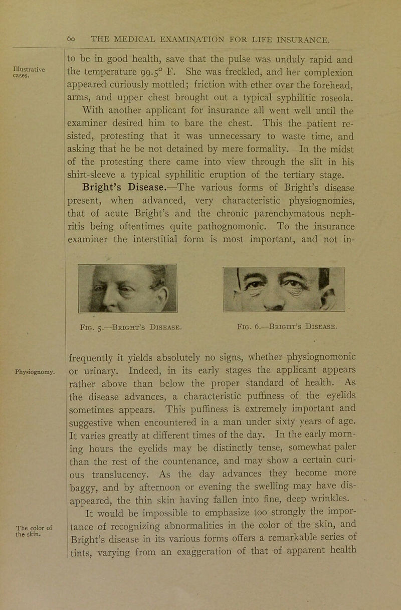 Illustrative cases. Physiognomy. The color of the skin. 60 THE MEDICAL EXAMINATION FOR LIFE INSURANCE. to be in good health, save that the pulse was unduly rapid and the temperature 99.50 F. She was freckled, and her complexion appeared curiously mottled; friction with ether over the forehead, arms, and upper chest brought out a typical syphilitic roseola. With another applicant for insurance all went well until the examiner desired him to bare the chest. This the patient re- sisted, protesting that it was unnecessary to waste time, and asking that he be not detained by mere formality. In the midst of the protesting there came into view through the slit in his shirt-sleeve a typical syphilitic eruption of the tertiary stage. Bright’s Disease.—The various forms of Bright’s disease present, when advanced, very characteristic physiognomies, that of acute Bright’s and the chronic parenchymatous neph- ritis being oftentimes quite pathognomonic. To the insurance examiner the interstitial form is most important, and not in- 3*? % f* Fig. 5.—Bright’s Disease. Fig. 6.—Bright’s Disease. frequently it yields absolutely no signs, whether physiognomonic or urinary. Indeed, in its early stages the applicant appears rather above than below the proper standard of health. As the disease advances, a characteristic puffiness of the eyelids sometimes appears. This puffiness is extremely important and suggestive when encountered in a man under sixty years of age. It varies greatly at different times of the day. In the early morn- ing hours the eyelids may be distinctly tense, somewhat paler than the rest of the countenance, and may show a certain curi- ous translucency. As the day advances they become more baggy, and by afternoon or evening the swelling may have dis- appeared, the thin skin having fallen into fine, deep wrinkles. It would be impossible to emphasize too strongly the impor- ' tance of recognizing abnormalities in the color of the skin, and Bright’s disease in its various forms offers a remarkable series of tints, varying from an exaggeration of that of apparent health