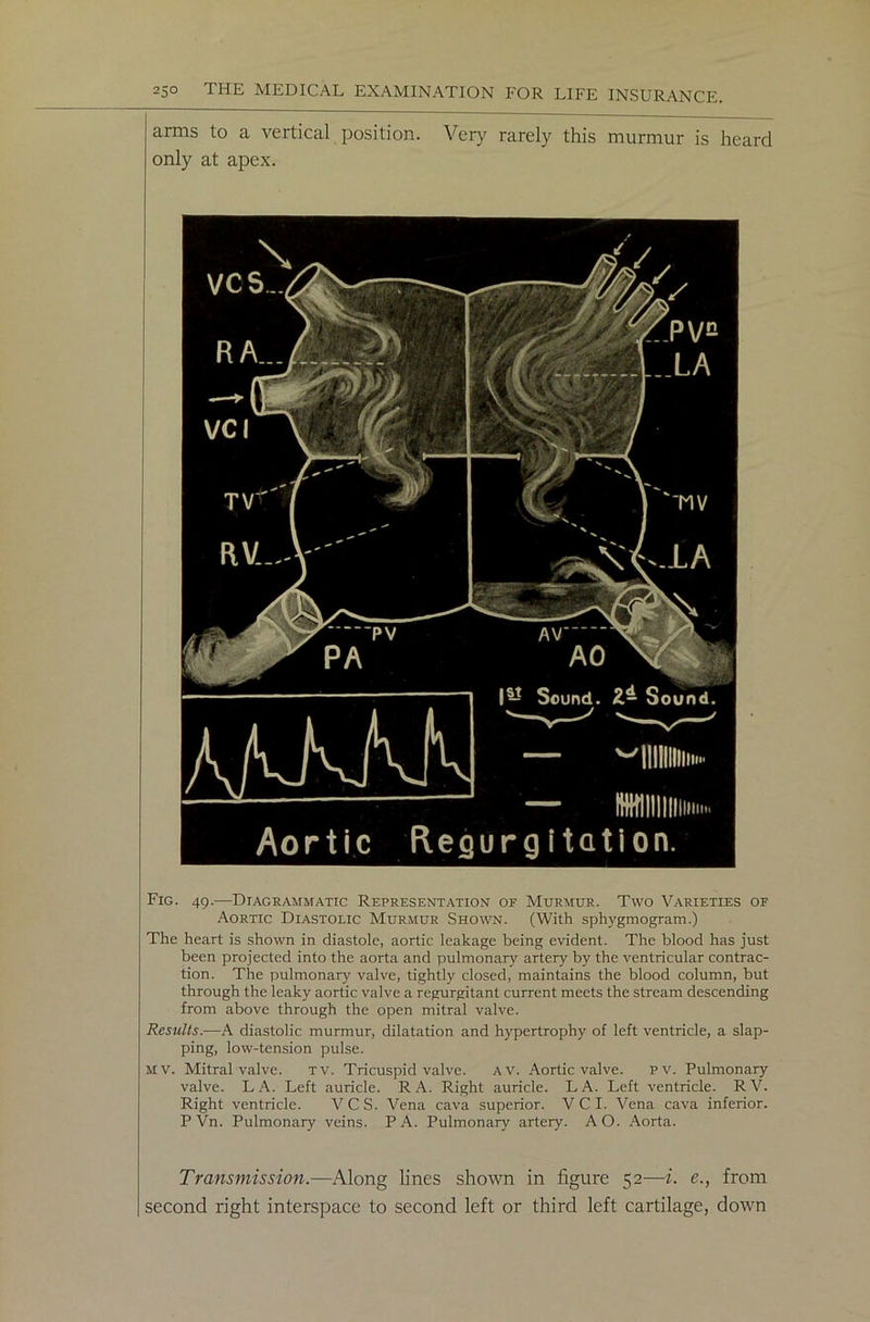 arms to a vertical position. Very rarely this murmur is heard only at apex. Fig. 49.—Diagrammatic Representation of Murmur. Two Varieties of Aortic Diastolic Murmur Shown. (With sphygmogram.) The heart is shown in diastole, aortic leakage being evident. The blood has just been projected into the aorta and pulmonary artery by the ventricular contrac- tion. The pulmonary valve, tightly closed, maintains the blood column, but through the leaky aortic valve a regurgitant current meets the stream descending from above through the open mitral valve. Results.—A diastolic murmur, dilatation and hypertrophy of left ventricle, a slap- ping, low-tension pulse. mv. Mitral valve. tv. Tricuspid valve. av. Aortic valve. pv. Pulmonary valve. LA. Left auricle. RA. Right auricle. LA. Left ventricle. RV. Right ventricle. VCS. Vena cava superior. V C I. Vena cava inferior. P Vn. Pulmonary veins. PA. Pulmonary artery. AO. Aorta. Transmission.—Along lines shown in figure 52—i. e., from second right interspace to second left or third left cartilage, down