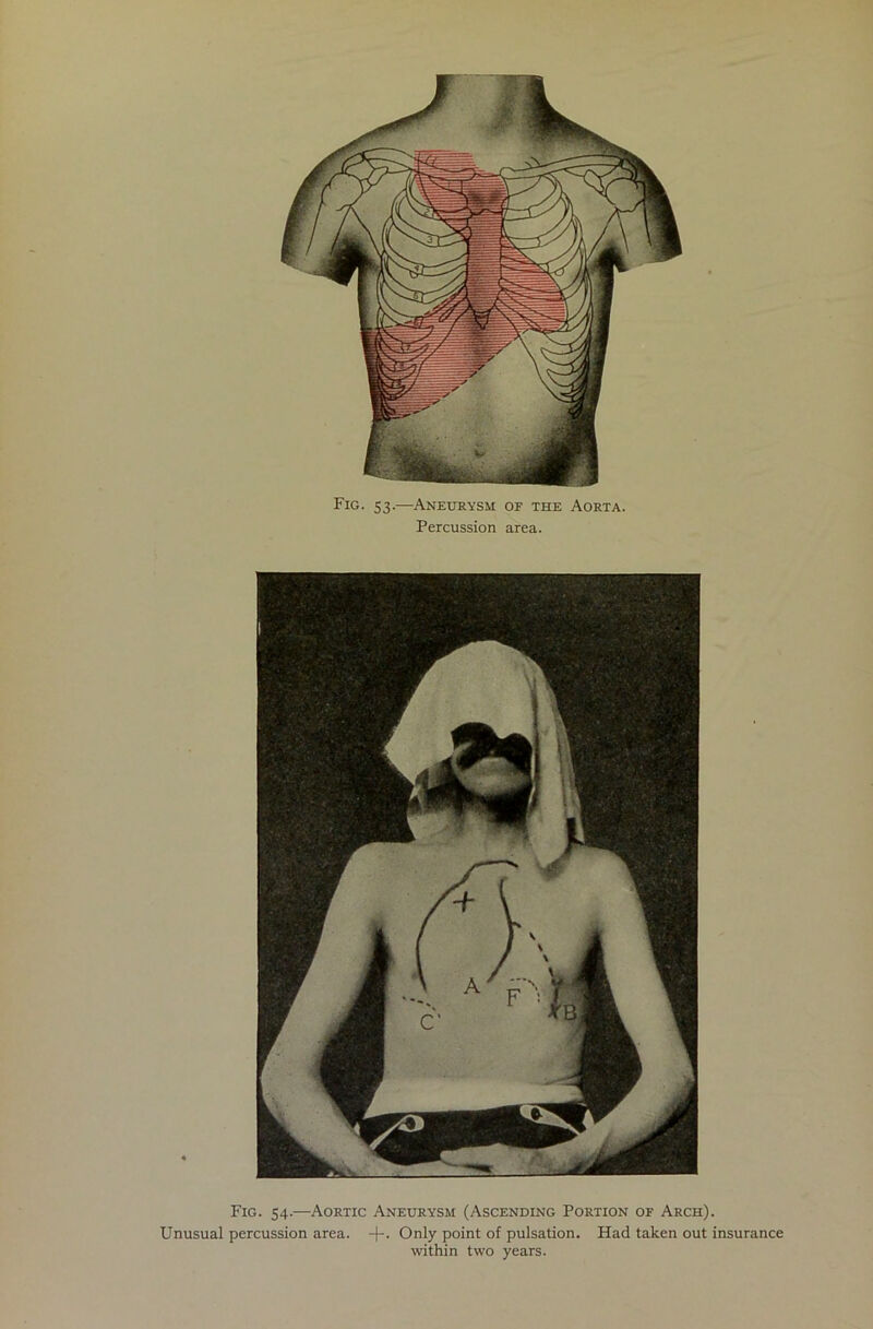 Fig. 53.—Aneurysm of the Aorta. Percussion area. Fig. 54.—Aortic Aneurysm (Ascending Portion of Arch). Unusual percussion area. -f-. Only point of pulsation. Had taken out insurance within two years.