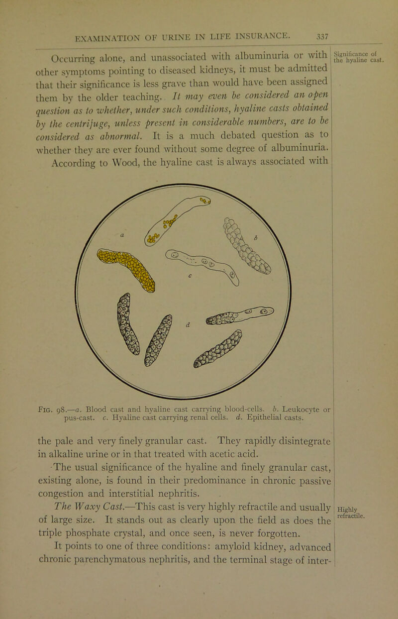 Occurring alone, and unassociated with albuminuria or with other symptoms pointing to diseased kidneys, it must be admitted that their significance is less grave than would have been assigned them by the older teaching. It may even be considered an open question as to whet her, under such conditions, hyaline casts obtained by the centrifuge, unless present in considerable numbers, are to be considered as abnormal. It is a much debated question as to whether they are ever found without some degree of albuminuria. According to Wood, the hyaline cast is always associated with Significance ot the hyaline cast. Fig. 98.—a. Blood cast and hyaline cast carrying blood-cells, b. Leukocyte or pus-cast. c. Hyaline cast carrying renal cells, d. Epithelial casts. the pale and very finely granular cast. They rapidly disintegrate in alkaline urine or in that treated with acetic acid. •The usual significance of the hyaline and finely granular cast, existing alone, is found in their predominance in chronic passive congestion and interstitial nephritis. The Waxy Cast.—This cast is very highly refractile and usually Highly of large size. It stands out as clearly upon the field as does the rcfrjc“1 triple phosphate crystal, and once seen, is never forgotten. It points to one of three conditions: amyloid kidney, advanced chronic parenchymatous nephritis, and the terminal stage of inter-