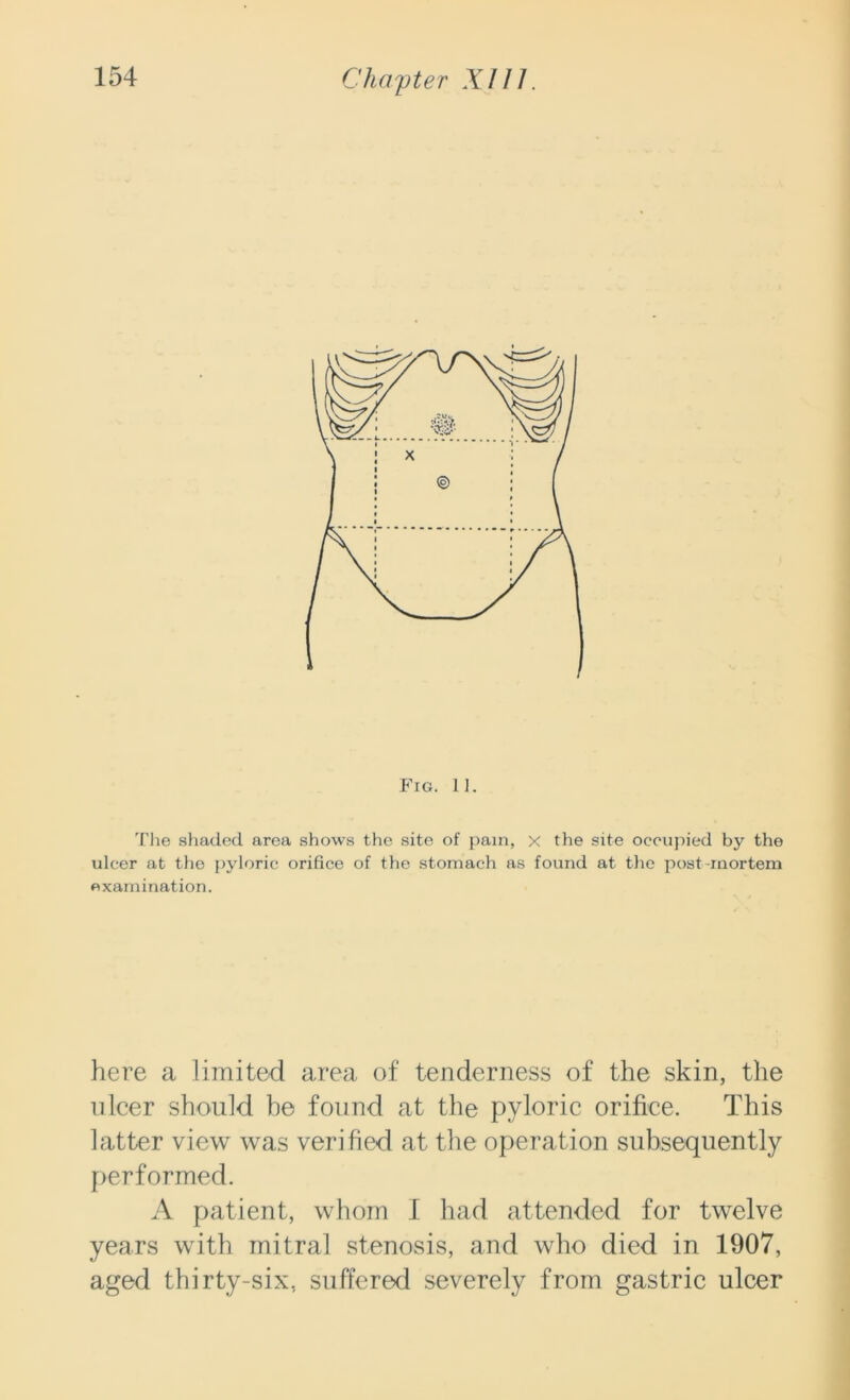 Fig. II. The shaded area shows the site of pain, x the site occupied by the ulcer at tho pyloric orifice of the stomach as found at the post-mortem examination. here a limited area of tenderness of the skin, the nicer should he found at the pyloric orifice. This latter view was verified at the operation subsequently performed. A patient, whom I had attended for twelve years with mitral stenosis, and who died in 1907, aged thirty-six, suffered severely from gastric ulcer