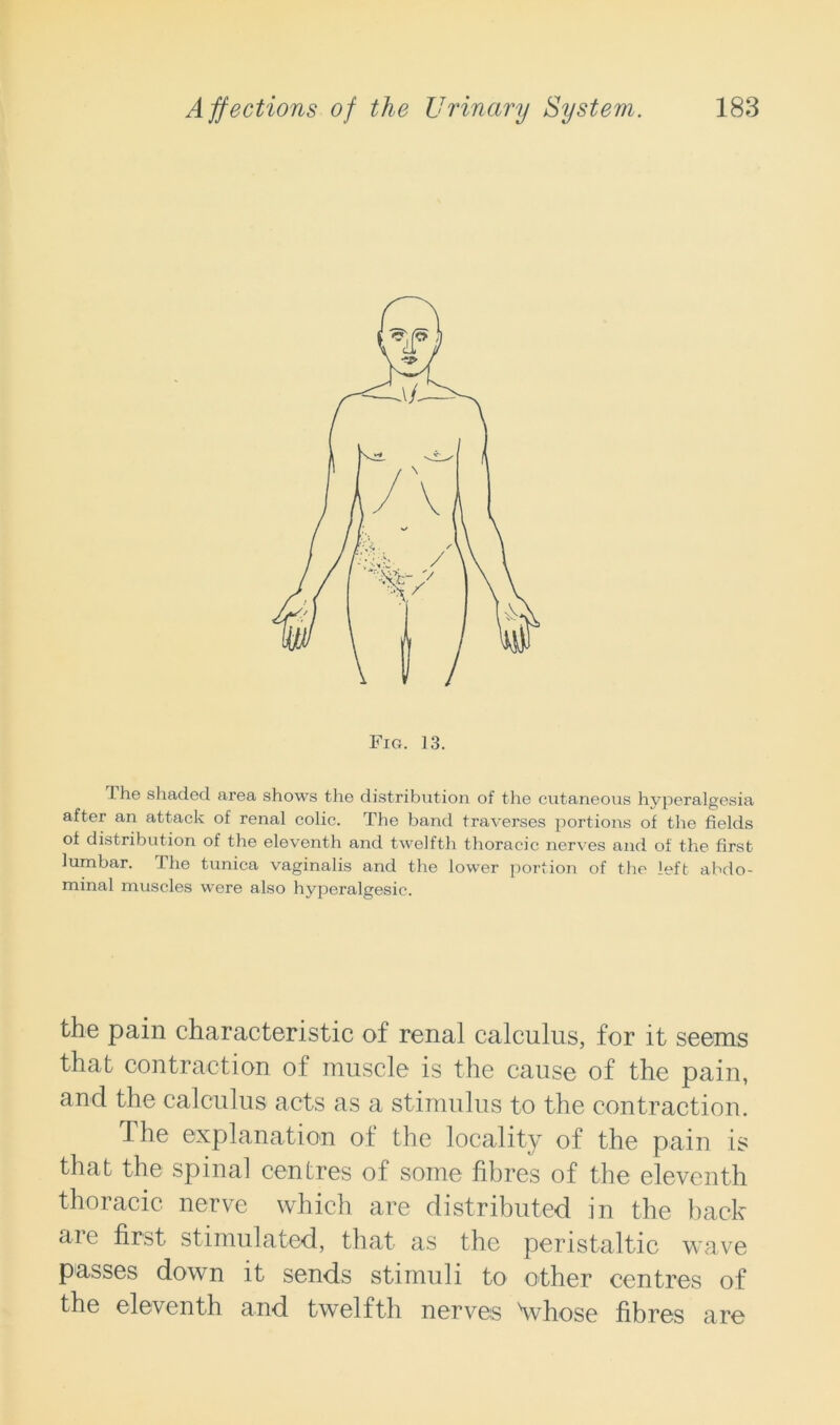 I he shaded area shows the distribution of the cutaneous hyperalgesia after an attack of renal colic. The band traverses portions of the fields of distribution of the eleventh and twelfth thoracic nerves and of the first lumbar. The tunica vaginalis and the lower portion of the left abdo- minal muscles were also hyperalgesie. the pain characteristic of renal calculus, for it seems that contraction of muscle is the cause of the pain, and the calculus acts as a stimulus to the contraction. The explanation of the locality of the pain is that the spinal centres of some fibres of the eleventh thoracic nerve which are distributed in the back are first stimulated, that as the peristaltic wave passes down it sends stimuli to other centres of the eleventh and twelfth nerves \vhose fibres are