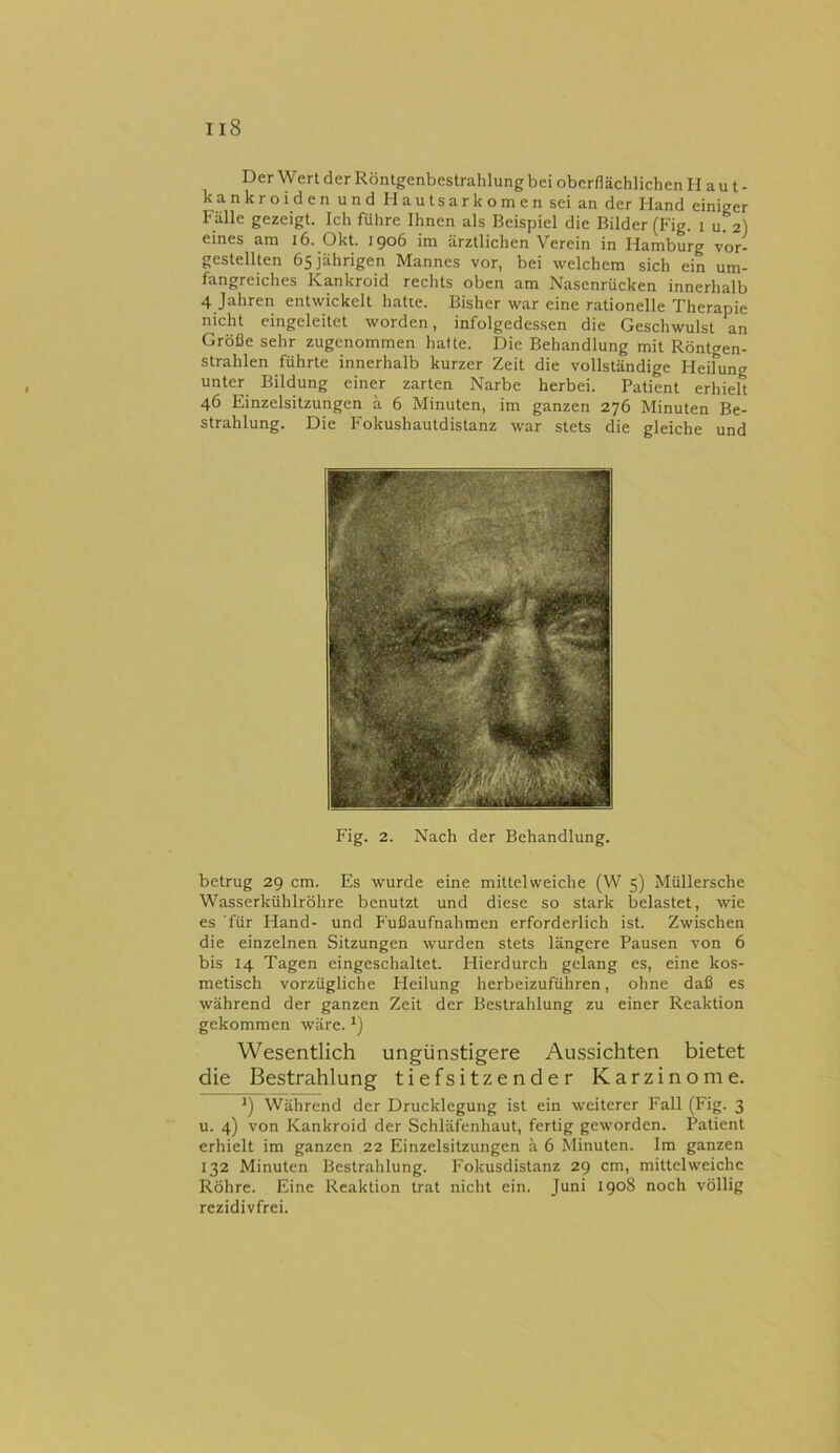 Der Wert der Röntgenbestrahlung bei oberflächlichen II a u t - hankroiden und Hautsarkomen sei an der Hand einiger Fälle gezeigt. Ich führe Ihnen als Beispiel die Bilder (Fig. i u. 2) eines am 16. Okt. 1906 im ärztlichen Verein in Hamburg vor- gestellten 65 jährigen Mannes vor, bei welchem sich ein um- fangreiches Kankroid rechts oben am Nasenrücken innerhalb 4 Jahren entwickelt hatte. Bisher war eine rationelle Therapie nicht eingeleitet worden, infolgedessen die Geschwulst an Größe sehr zugenommen hatte. Die Behandlung mit Röntgen- strahlen führte innerhalb kurzer Zeit die vollständige Heilung unter Bildung einer zarten Narbe herbei. Patient erhielt 46 Einzelsitzungen ä 6 Minuten, im ganzen 276 Minuten Be- strahlung. Die Fokushautdistanz war stets die gleiche und Fig. 2. Nach der Behandlung. betrug 29 cm. Es wurde eine mittelweiche (W 5) Müllersche Wasserkühlröhre benutzt und diese so stark belastet, wie es für Hand- und Fußaufnahmen erforderlich ist. Zwischen die einzelnen Sitzungen wurden stets längere Pausen von 6 bis 14 Tagen eingeschaltet. Hierdurch gelang es, eine kos- metisch vorzügliche Heilung herbeizuführen, ohne daß es während der ganzen Zeit der Bestrahlung zu einer Reaktion gekommen wäre. *) Wesentlich ungünstigere Aussichten bietet die Bestrahlung tiefsitzender Karzinome. *) Während der Drucklegung ist ein weiterer Fall (Fig. 3 u. 4) von Kankroid der Schläfenhaut, fertig geworden. Patient erhielt im ganzen 22 Einzelsitzungen ä 6 Minuten. Im ganzen 132 Minuten Bestrahlung. Fokusdistanz 29 cm, mittelweichc Röhre. Eine Reaktion trat nicht ein. Juni 1908 noch völlig rezidivfrei.