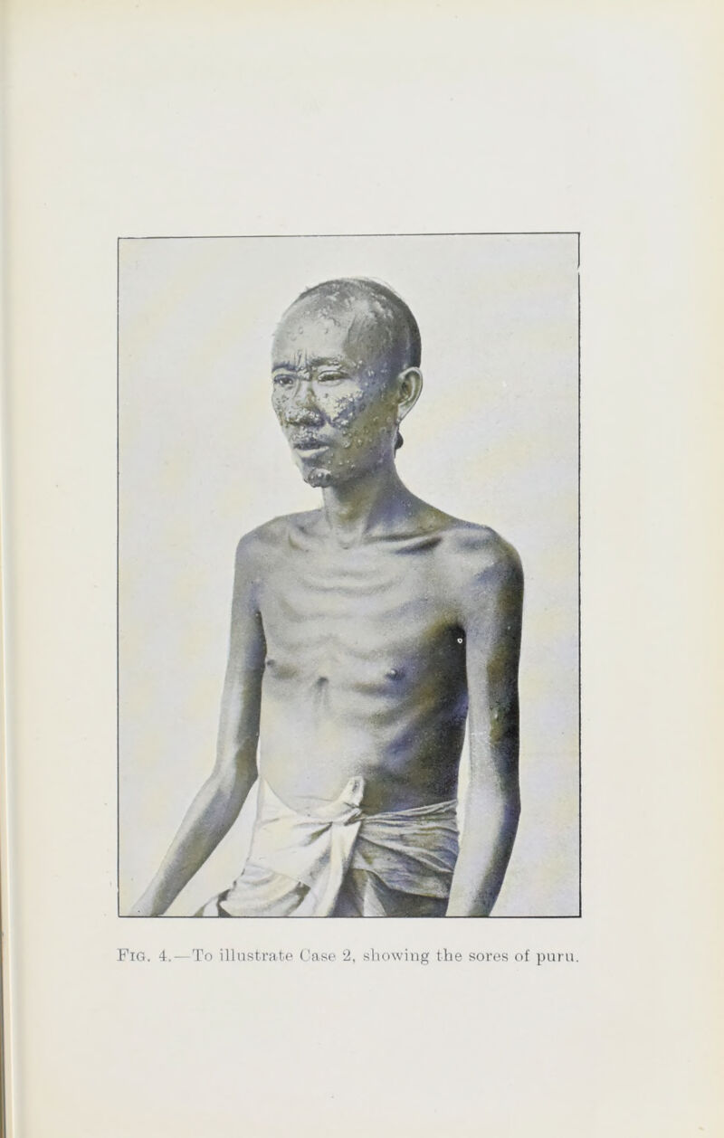 Fig. 4.—To illustrate Case 2, showing the sores of puru.