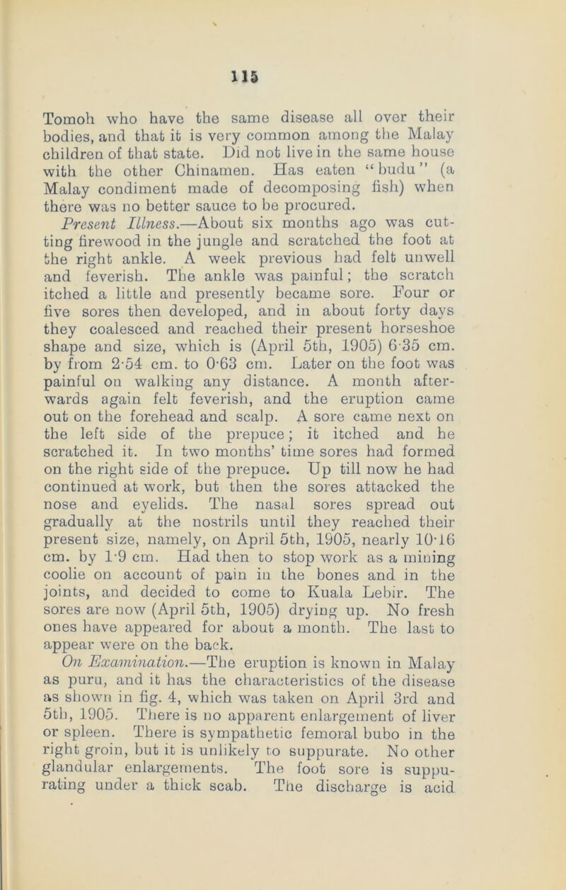 Tomoh who have the same disease all over their bodies, and that it is very common among the Malay children of that state. Did not live in the same house with the other Chinamen. Has eaten “ budu ” (a Malay condiment made of decomposing fish) when there was no better sauce to be procured. Present Illness.—About six months ago was cut- ting firewood in the jungle and scratched the foot at the right ankle. A week previous had felt unwell and feverish. The ankle was painful; the scratch itched a little and presently became sore. Four or five sores then developed, and in about forty days they coalesced and reached their present horseshoe shape and size, which is (April 5th, 1905) 6 35 cm. by from 2-54 cm. to 0-63 cm. Later on the foot was painful on walking any distance. A month after- wards again felt feverish, and the eruption came out on the forehead and scalp. A sore came next on the left side of the prepuce; it itched and he scratched it. In two months’ time sores had formed on the right side of the prepuce. Up till now he had continued at work, but then the sores attacked the nose and eyelids. The nasal sores spread out gradually at the nostrils until they reached their present size, namely, on April 5th, 1905, nearly 10-16 cm. by 1-9 cm. Had then to stop work as a mining coolie on account of pain in the bones and in the joints, and decided to come to Kuala Lebir. The sores are now (April 5th, 1905) drying up. No fresh ones have appeared for about a month. The last to appear were on the back. On Examination.—The eruption is known in Malay as puru, and it has the characteristics of the disease as shown in fig. 4, which was taken on April 3rd and 5th, 1905. There is no apparent enlargement of liver or spleen. There is sympathetic femoral bubo in the right groin, but it is unlikely to suppurate. No other glandular enlargements. The foot sore is suppu- rating under a thick scab. The discharge is acid
