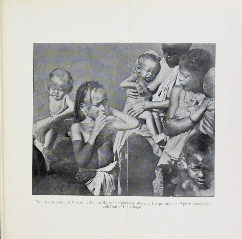 Kro. 5.—A group of Malays at Dusun Nyor, in Kelantau, showing the prevalence of puru among the children of the village.