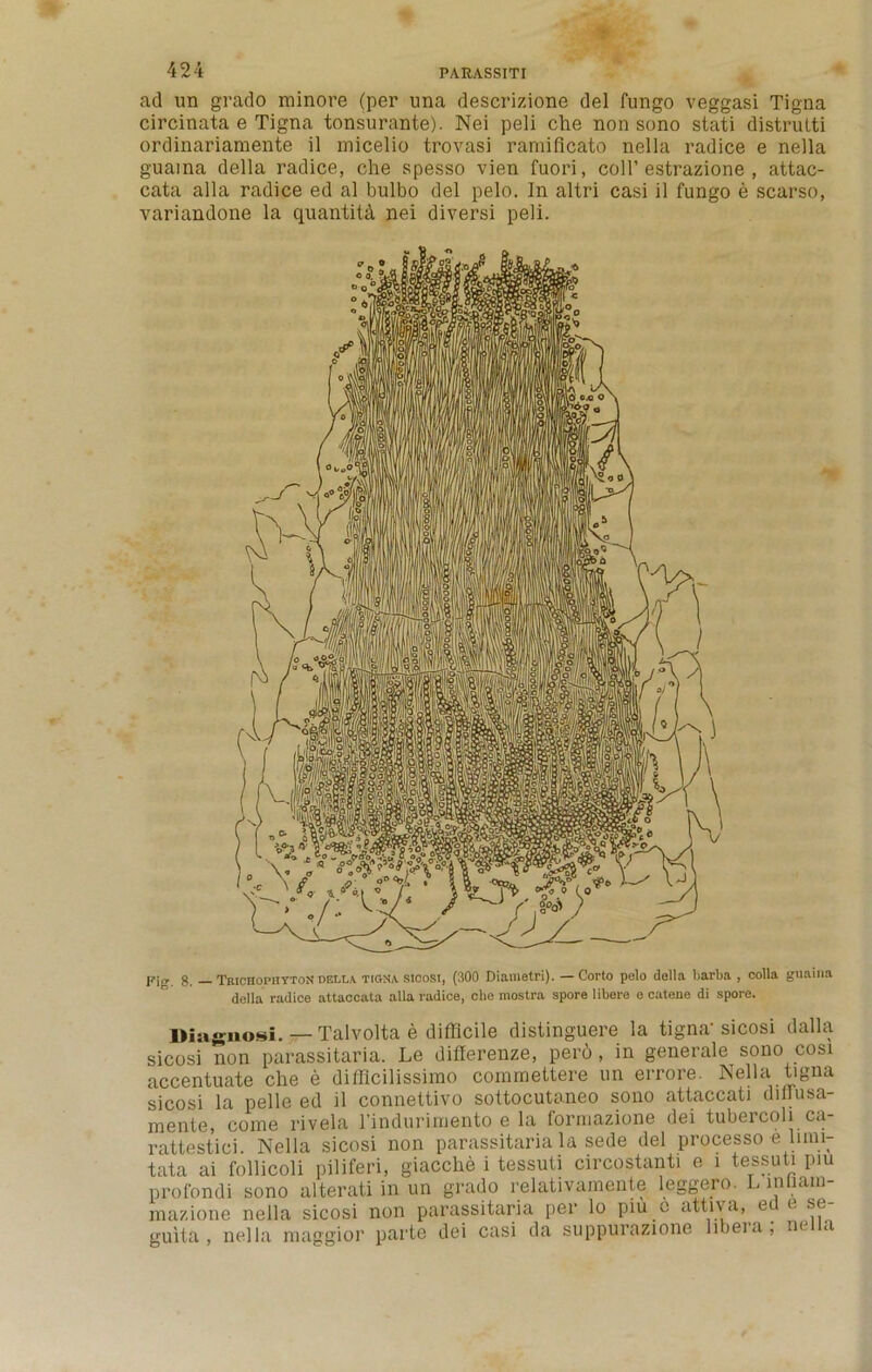 ad un grado minore (per una descrizione del fungo veggasi Tigna circinata e Tigna tonsurante). Nei peli che non sono stati distrutti ordinariamente il micelio trovasi ramificato nella radice e nella guaina della radice, che spesso vien fuori, coll’ estrazione , attac- cata alia radice ed al bulbo del pelo. In altri casi il fungo e scarso, variandone la quantity nei diversi peli. Pig 8. — Trichophyton della tigna sicosi, (300 Diametri). — Corto pelo della barba , colla guaina della radice attaccata alia radice, che mostra spore libere e catene di spore. Diagnosi.— Talvolta e difficile distinguere la tigna' sicosi dalla sicosi non parassitaria. Le differenze, pero , in generale sono cosi accentuate che e difflcilissimo commettere un errore. Nella tigna sicosi la pelle ed il connettivo sottocutaneo sono attaccati dilrusa- mente, come rivela l’indurimento e la formazione dei tubercoli ca- rattestici. Nella sicosi non parassitaria la sede del processo e luni- tata ai follicoli piliferi, giacche i tessuti circostanti e 1 tessuti piu profondi sono alterati in un grado relativamente leggcio. L in lain mazione nella sicosi non parassitaria per lo piu c attiva, ed e se- guita , nella maggior parte dei casi da suppurazione libei a, m a