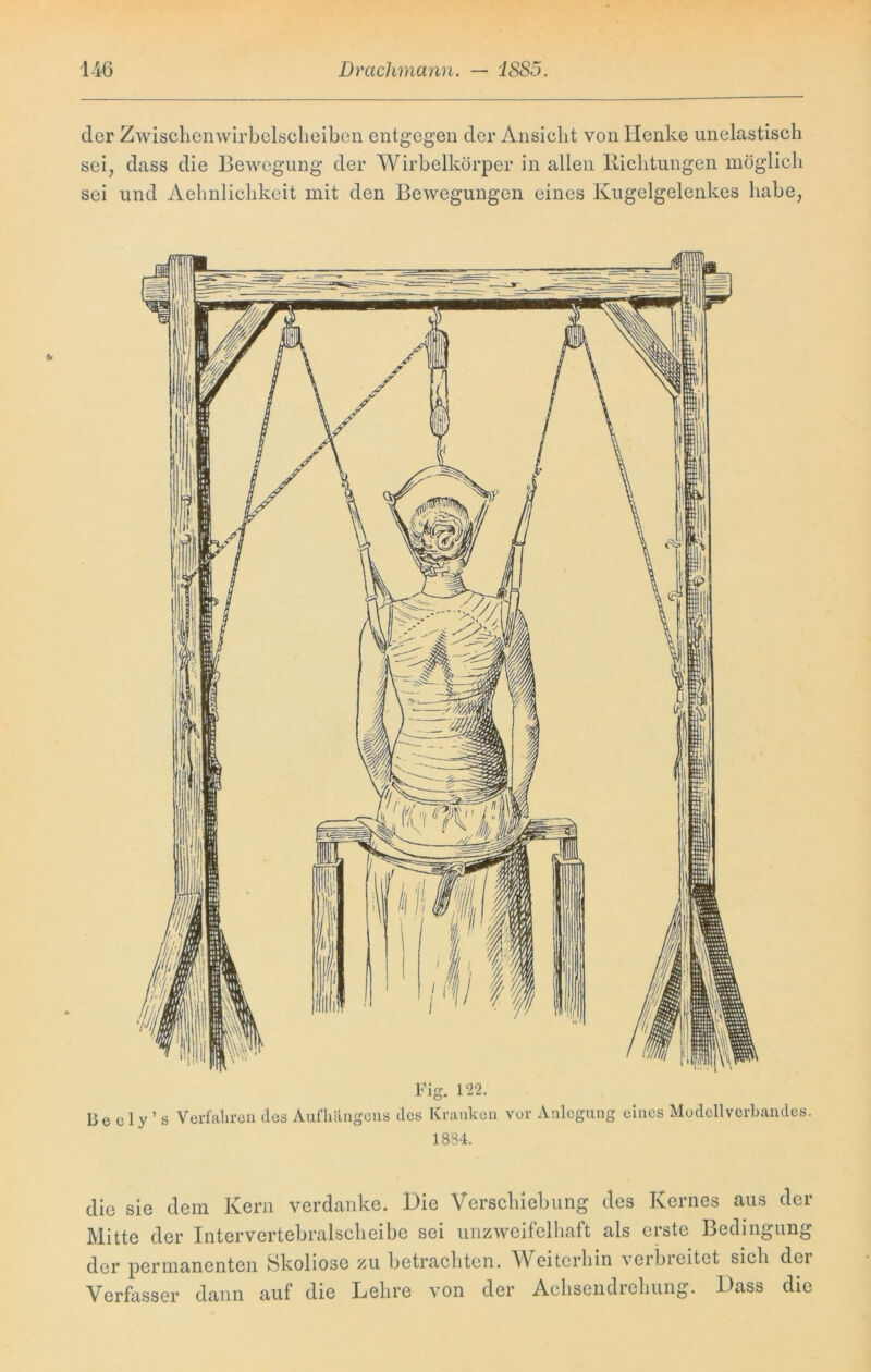 der Zwischenwirbelscheiben entgegen der Ansicht von Henke unelastisch sei, dass die Bewegung der Wirbelkörper in allen Richtungen möglich sei und Aehnlichkeit mit den Bewegungen eines Kugelgelenkes habe, Flg. 122. Be c 1 y ’ s Verfahren des Aufhängens des Kranken vor Anlegung eines Modellverbandes. 1834. die sie dem Kern verdanke. Die Verschiebung des Kernes aus der Mitte der Intervertebralscheibe sei unzweifelhaft als erste Bedingung der permanenten Skoliose zu betrachten. Weiterhin verbreitet sich dei Verfasser dann auf die Lehre von der Achsendrehung. Dass die