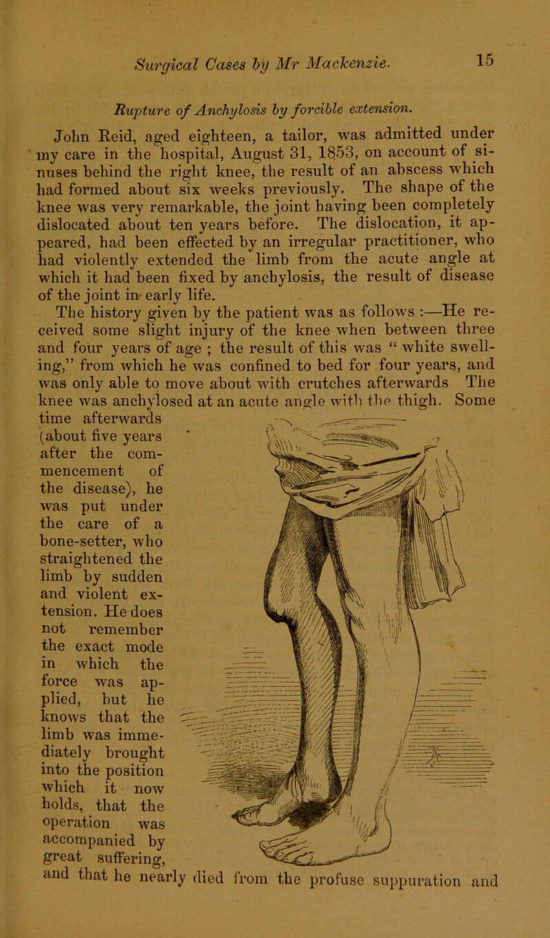 Rupture of Anchylosis by forcible extension. John Reid, aged eighteen, a tailor, was admitted under my care in the hospital, August 31, 1853, on account of si- nuses behind the right knee, the result of an abscess which had formed about six weeks previously. The shape of the knee was very remarkable, the joint having been completely dislocated about ten years before. The dislocation, it ap- peared, had been effected by an irregular practitioner, who had violently extended the limb from the acute angle at which it had been fixed by anchylosis, the result of disease of the joint in early life. The history given by the patient was as follows :—He re- ceived some slight injury of the knee when between three and four years of age ; the result of this was “ white swell- ing,” from which he was confined to bed for four years, and was only able to move about with crutches afterwards The knee was anchylosed at an acute angle with the thigh. Some time afterwards (about five years after the com- mencement of the disease), he was put under the care of a bone-setter, who straightened the limb by sudden and violent ex- tension. He does not remember the exact mode in which the force was plied, but knows that the limb was imme- diately brought into the position which it now holds, that the operation was accompanied by great suffering, and that he nearly died from the profuse suppuration and ap- he