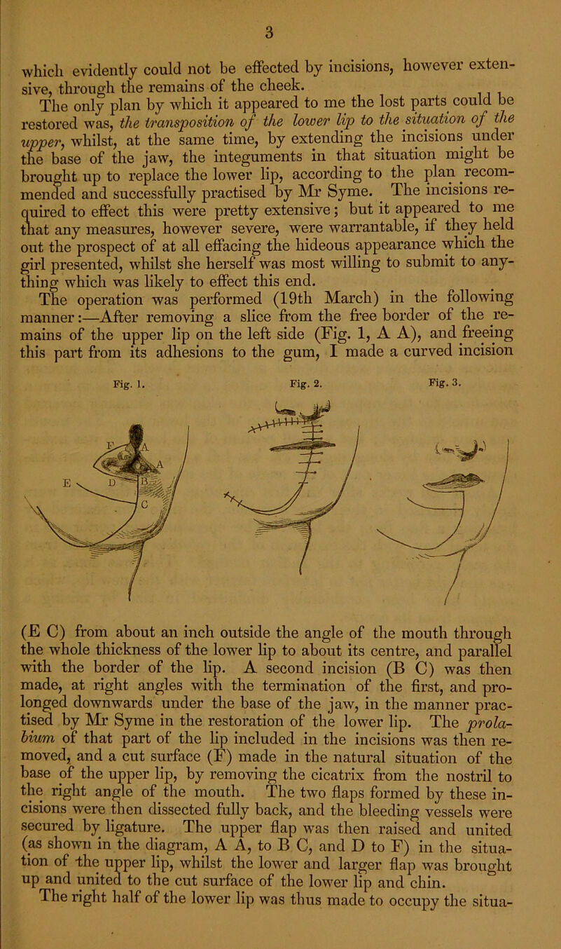 which evidently could not be effected by incisions, however exten- sive, through the remains of the cheek. The only plan by which it appeared to me the lost parts could be restored was, the transposition of the lower lip to the situation of the upper, whilst, at the same time, by extending the incisions under the base of the jaw, the integuments in that situation might be brought up to replace the lower lip, according to the plan recom- mended and successfully practised by Mr Syme. The incisions re- quired to effect this were pretty extensive; but it appeared to me that any measures, however severe, were warrantable, if they held out the prospect of at all effacing the hideous appearance which the girl presented, whilst she herself was most willing to submit to any- thing which was likely to effect this end. The operation was performed (19th March) in the following manner:—After removing a slice from the free border of the re- mains of the upper lip on the left side (Fig. 1, A A), and freeing this part from its adhesions to the gum, I made a curved incision Fig. 1. Fig. 2. Fig. 3. (E C) from about an inch outside the angle of the mouth through the whole thickness of the lower lip to about its centre, and parallel with the border of the lip. A second incision (B C) was then made, at right angles with the termination of the first, and pro- longed downwards under the base of the jaw, in the manner prac- tised by Mr Syme in the restoration of the lower lip. The prola- bium of that part of the lip included in the incisions was then re- moved, and a cut surface (F) made in the natural situation of the base of the upper lip, by removing the cicatrix from the nostril to the right angle of the mouth. The two flaps formed by these in- cisions -were then dissected fully back, and the bleeding vessels were secured by ligature. The upper flap was then raised and united (as shown in the diagram, A A, to B C, and D to F) in the situa- tion of -the upper lip, whilst the lower and larger flap was brought up and united to the cut surface of the lower lip and chin. The right half of the lower lip was thus made to occupy the situa-