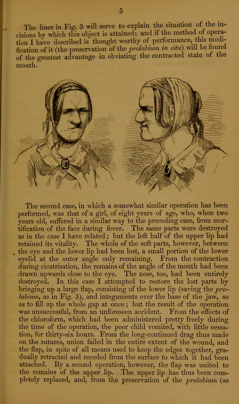 The lines in Fig. 3 will serve to explain the situation of the in- cisions by which this object is attained; and if the method of opera- tion I have described is thought worthy of performance, this modi- fication of it (the preservation of the prolabium in situ) will be found of the greatest advantage in obviating the contracted state of the mouth. The second case, in which a somewhat similar operation has been performed, was that of a girl, of eight years of age, who, when two years old, suffered in a similar way to the preceding case, from mor- tification of the face during fever. The same parts were destroyed as in the case I have related; but the left half of the upper lip had retained its vitality. The whole of the soft parts, however, between the eye and the lower lip had been lost, a small portion of the lower eyelid at the outer angle only remaining. From the contraction during cicatrisation, the remains of the angle of the mouth had been drawn upwards close to the eye. The nose, too, had been entirely destroyed. In this case I attempted to restore the lost parts by bringing up a large flap, consisting of the lower lip (saving the pro- labium, as in Fig. 3), and integuments over the base of the jaw, so as to fill iip the whole gap at once; but the result of the operation was unsuccessful, from an unforeseen accident. From the effects of the chloroform, which had been administered pretty freely during the time of the operation, the poor child vomited, with little cessa- tion, for thirty-six hours. From the long-continued drag thus made on the sutures, union failed in the entire extent of the wound, and the flap, in spite of all means used to keep the edges together, gra- dually retracted and receded from the surface to which it had been attached. By a second operation, however, the flap was united to the remains of the upper lip. The upper lip has thus been com- pletely replaced, and, from the preservation of the prolabium (as