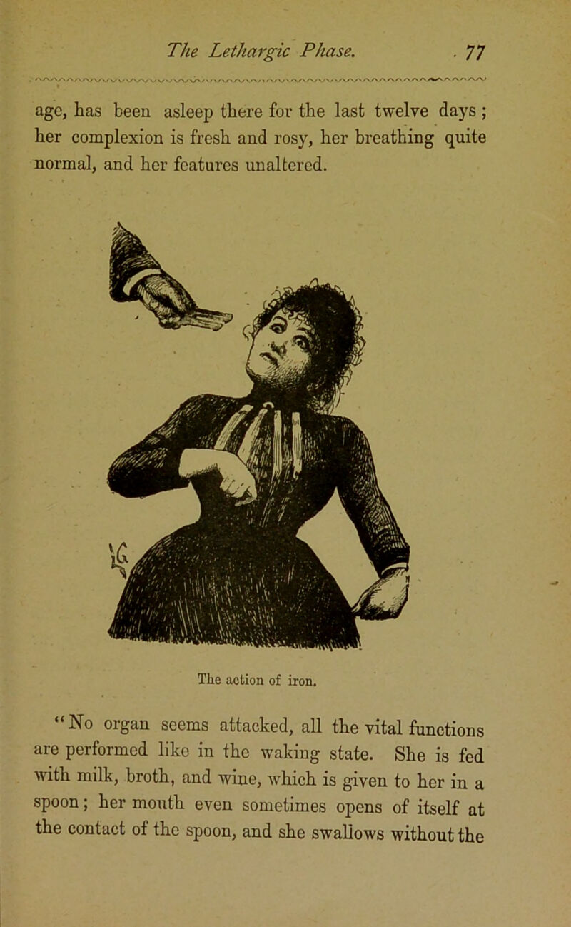 age, has been asleep there for the last twelve days ; her complexion is fresh and rosy, her breathing quite normal, and her features unaltered. The action of iron. “No organ seems attacked, all the vital functions are performed like in the waking state. She is fed with milk, broth, and wine, which is given to her in a spoon; her mouth even sometimes opens of itself at the contact of the spoon, and she swallows without the