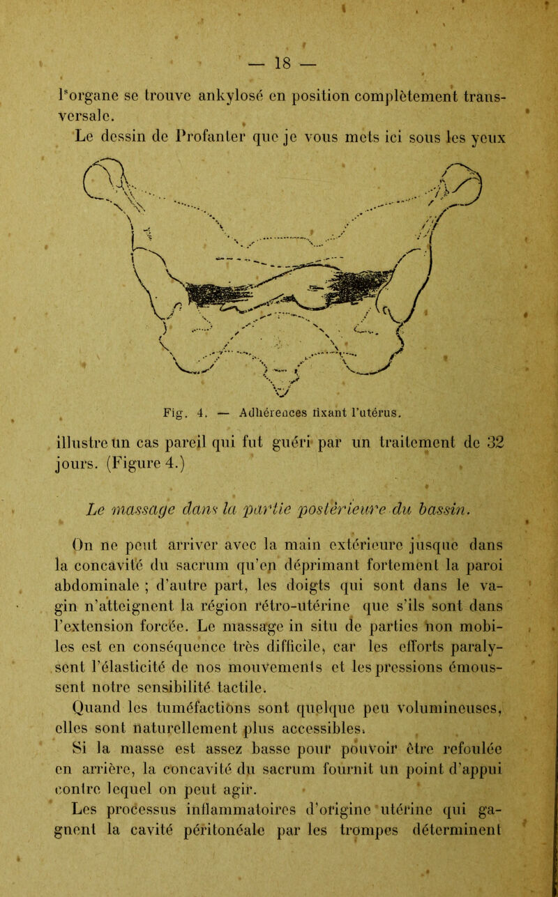 Porgane se trouve ankylosé en position complètement trans- versale. Le dessin de Profanter que je vous mets ici sous les yeux illustre un cas pareil qui fut guéri' par un traitement de 32 jours. (Figure 4.) Le massage clans la partie postérieure du bassin. On ne peut arriver avec la main extérieure jusque dans la concavité du sacrum qu’en déprimant fortement la paroi abdominale ; d’autre part, les doigts qui sont dans le va- gin n’atteignent la région rétro-utérine que s’ils sont dans l’extension forcée. Le massage in situ de parties non mobi- les est en conséquence très difficile, car les efforts paraly- sent l’élasticité de nos mouvemenis et les pressions émous- sent notre sensibilité tactile. Quand les tuméfactions sont quelque peu volumineuses, elles sont ilaturellement plus accessibles * Si la masse est assez basse pour pouvoir être refoulée en arrière, la concavité du sacrum fournit Un point d’appui conire lequel on peut agir. Les processus inflammatoires d’origine utérine qui ga- gnent la cavité péritonéale par les trompes déterminent