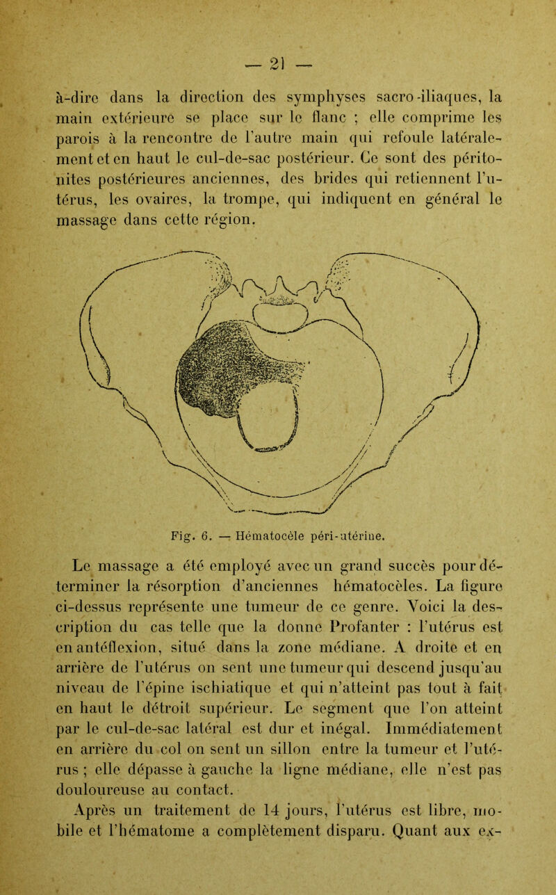 à-dire dans la direction des symphyses sacro-iliaques, la main extérieure se place sur le flanc ; elle comprime les parois à la rencontre de l’autre main qui refoule latérale- ment et en haut le cul-de-sac postérieur. Ce sont des périto- nites postérieures anciennes, des brides qui retiennent l’u- térus, les ovaires, la trompe, qui indiquent en général le massage dans cette région. Fig. 6. — Hématocèle péri-utériae. Le massage a été employé avec un grand succès pour dé- terminer la résorption d’anciennes hématocèles. La figure ci-dessus représente une tumeur de ce genre. Yoici la des- cription du cas telle que la donne Profanter : Futérus est en antéflexion, situé dans la zone médiane. A droite et en arrière de Futérus on sent une tumeur qui descend jusqu’au niveau de l’épine ischiatique et qui n’atteint pas tout à fait en haut le détroit supérieur. Le segment que l’on atteint par le cul-de-sac latéral est dur et inégal. Immédiatement en arrière du col on sent un sillon entre la tumeur et l’uté- rus ; elle dépasse à gauche la ligne médiane, elle n’est pas douloureuse au contact. Après un traitement de 14 jours, Futérus est libre, mo- bile et l’hématome a complètement disparu. Quant aux ex-