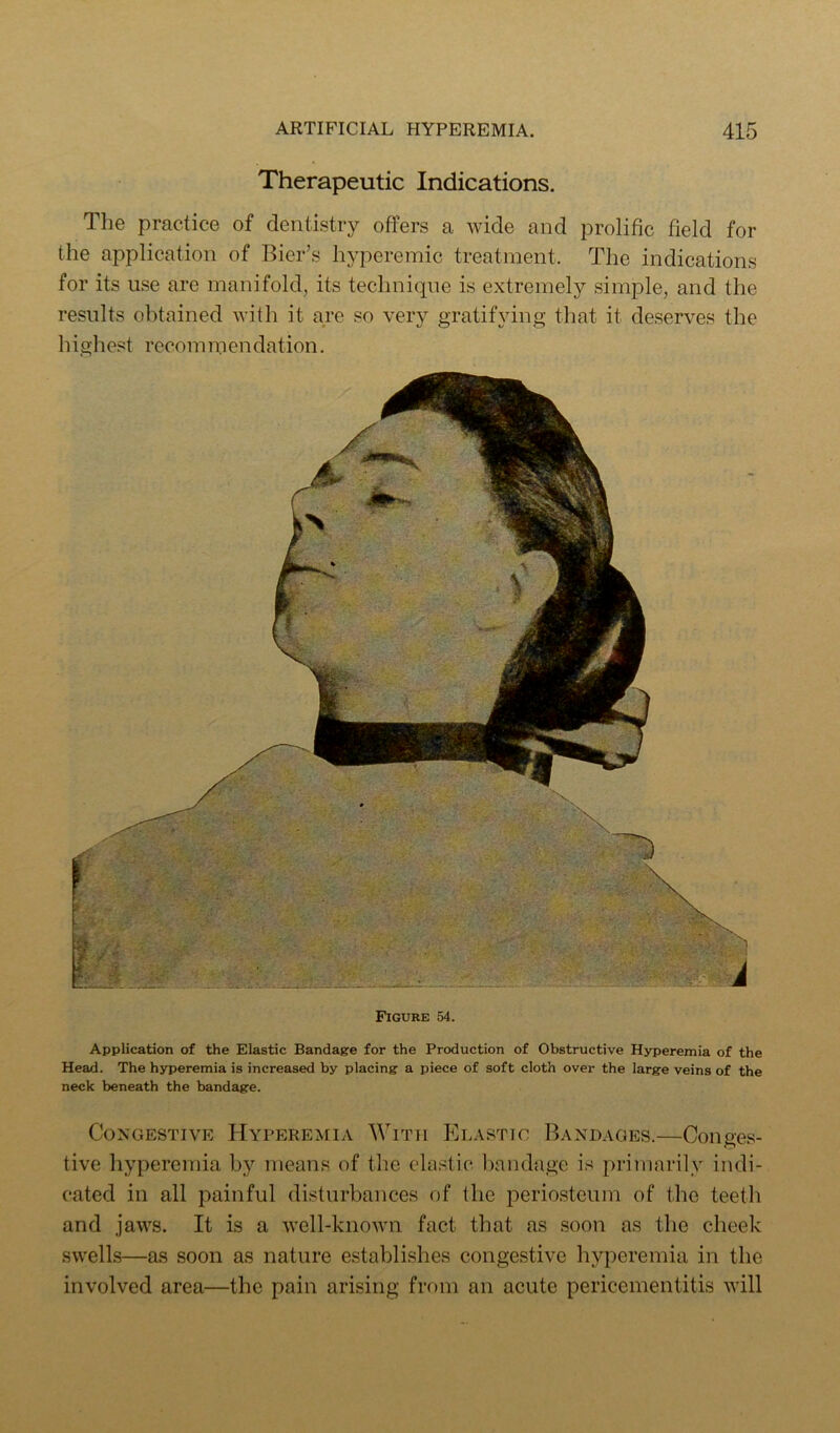 Therapeutic Indications. The practice of dentistry offers a wide and prolific field for the application of Bier’s hyperemic treatment. The indications for its use are manifold, its technique is extremely simple, and the results obtained Avith it are so very gratifying that it deserves the highest rccommendation. Figure 54. Application of the Elastic Bandage for the Production of Obstructive Hyperemia of the Head. The hyperemia is increased by placing a piece of soft cloth over the large veins of the neck beneath the bandage. Congestive Hyperemia With Elastic Bandages.—Conges- tive hyperemia by means of the clastic bandage is primarily indi- cated in all painful disturbances of the periosteum of the teeth and jaws. It is a Avell-knoAvn fact that as soon as the cheek swells—as soon as nature establishes congestive hyperemia in the involved area—the pain arising from an acute pericementitis Avill