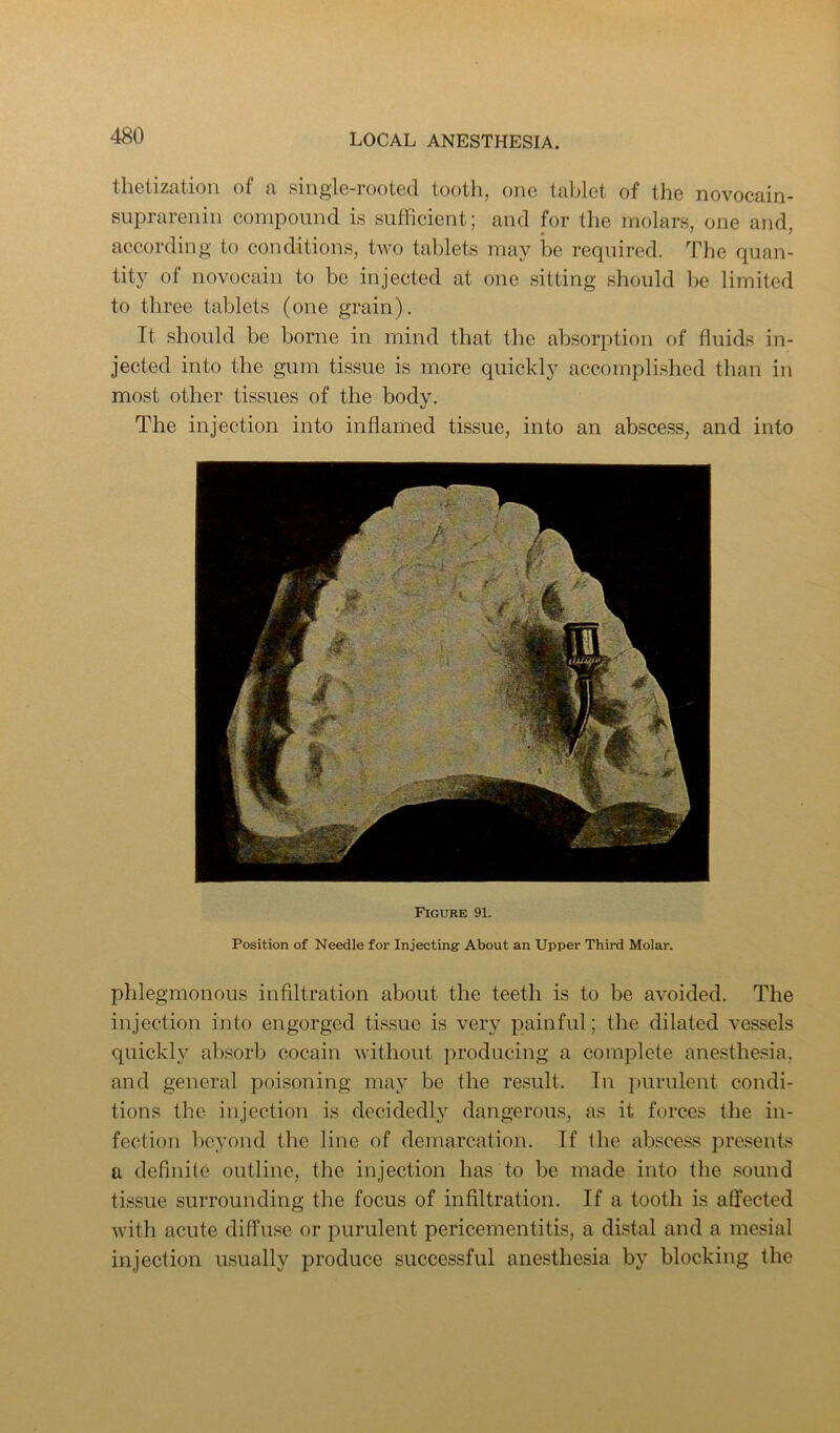 tliGtizcitioii of fi singlc-rootcd tootlij one tublet of the novocciin- siiprarenin compound is sufficient; and for the molars, one and according to conditions, two tablets may be required. The quan- tity of novocain to be injected at one sitting should be limited to three tablets (one grain). It should be borne in mind that the absorption of fluids in- jected into the gum tissue is more quickly accomplished than in most other tissues of the body. The injection into inflamed tissue, into an abscess, and into Figure 91. Position of Needle for Injecting’ About an Upper Third Molar. phlegmonous infiltration about the teeth is to be avoided. The injection into engorged tissue is very painful; the dilated vessels quickly absorb cocain without producing a complete ane.sthesia. and general poisoning may be the result. In purulent condi- tions the injection is decidedly dangerous, as it forces the in- fection beyond the line of demarcation. If the akscess presents a definite outline, the injection has to be made into the sound tissue surrounding the focus of infiltration. If a tooth is affected with acute diffuse or purulent pericementitis, a distal and a mesial injection usually produce successful anesthesia by blocking the