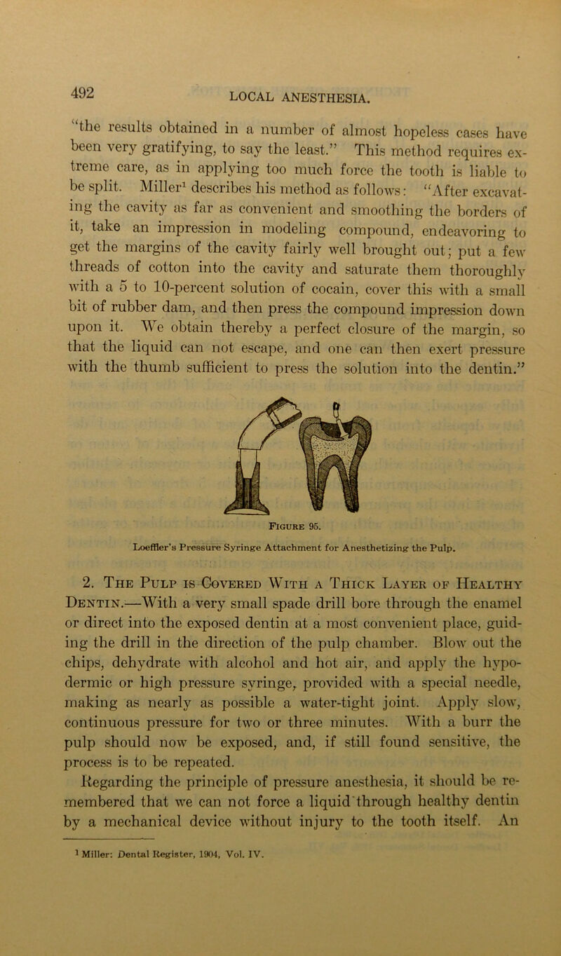 “the results obtained in a number of almost hopeless cases have been very gratifying, to say the least.” This method requires ex- treme care, as in applying too much force the tooth is liable to be split. Miller^ describes his method as follows: “After excavat- ing the cavity as far as convenient and smoothing the borders of it, take an impression in modeling compound, endeavoring to get the margins of the cavity fairly well brought out; put a few threads of cotton into the cavity and saturate them thoroughly with a 5 to 10-percent solution of cocain, cover this with a small bit of rubber dam, and then press the compound impression down upon it. We obtain thereby a perfect closure of the margin, so that the liquid can not escape, and one can then exert pressure with the thumb sufficient to press the solution into the dentin.” Figure 96. Loeffler’s Pressure Syringe Attachment for Anesthetizing the Pulp. 2. The Pulp is Covered With a Thick Layer of Healthy Dentin.—With a very small spade drill bore through the enamel or direct into the exposed dentin at a most convenient place, guid- ing the drill in the direction of the pulp chamber. Blow out the chips, dehydrate with alcohol and hot air, and apply the hypo- dermic or high pressure syringe^ provided with a special needle, making as nearly as possible a water-tight joint. Apply slow, continuous pressure for two or three minutes. With a burr the pulp should now be exposed, and, if still found sensitive, the process is to be repeated. Regarding the principle of pressure anesthesia, it should be re- membered that we can not force a liquid‘through healthy dentin by a mechanical device without injury to the tooth itself. An ^ Miller: Dental Register, 1904, Vol. IV.