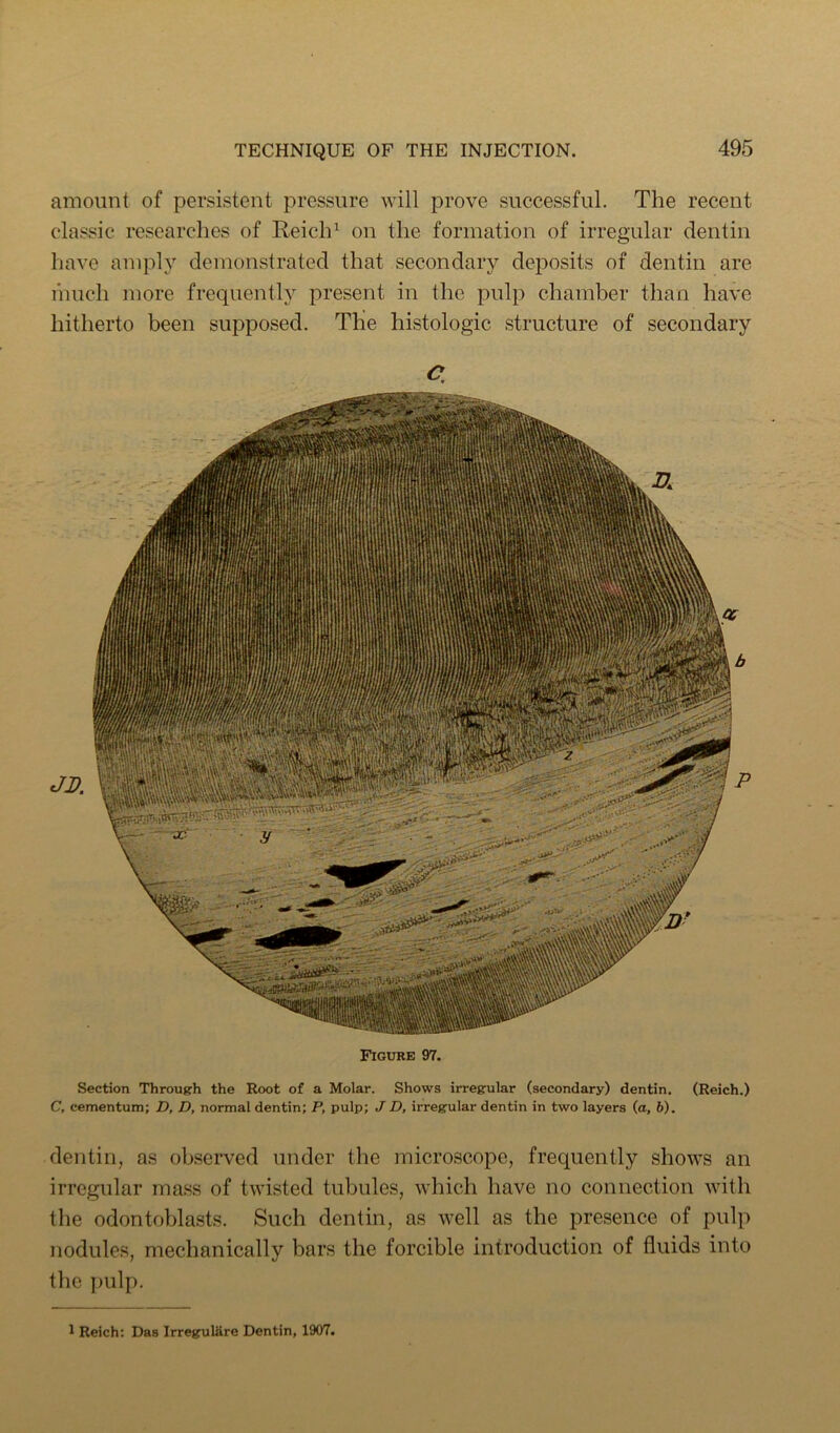 amount of persistent pressure will prove successful. The recent classic researches of ReiclU on the formation of irregular dentin have amph^ demonstrated that secondary dej^osits of dentin are I’nuch more frequently present in the pulp chamber than have hitherto been supposed. The histologic structure of secondary C, Figure 97. Section Through the Root of a Molar. Shows irregular (secondary) dentin. (Reich.) C, cementum; D, D, normal dentin; P, pulp; JD, irregular dentin in two layers (a, b). dentin, as observed under the microscope, frequently shows an irregular mass of twisted tubules, which have no connection with the odontoblasts. Such dentin, as well as the presence of pulp nodules, mechanically bars the forcible introduction of fluids into the imlp. 1 Reich; Das Irregulilre Dentin, 1907.