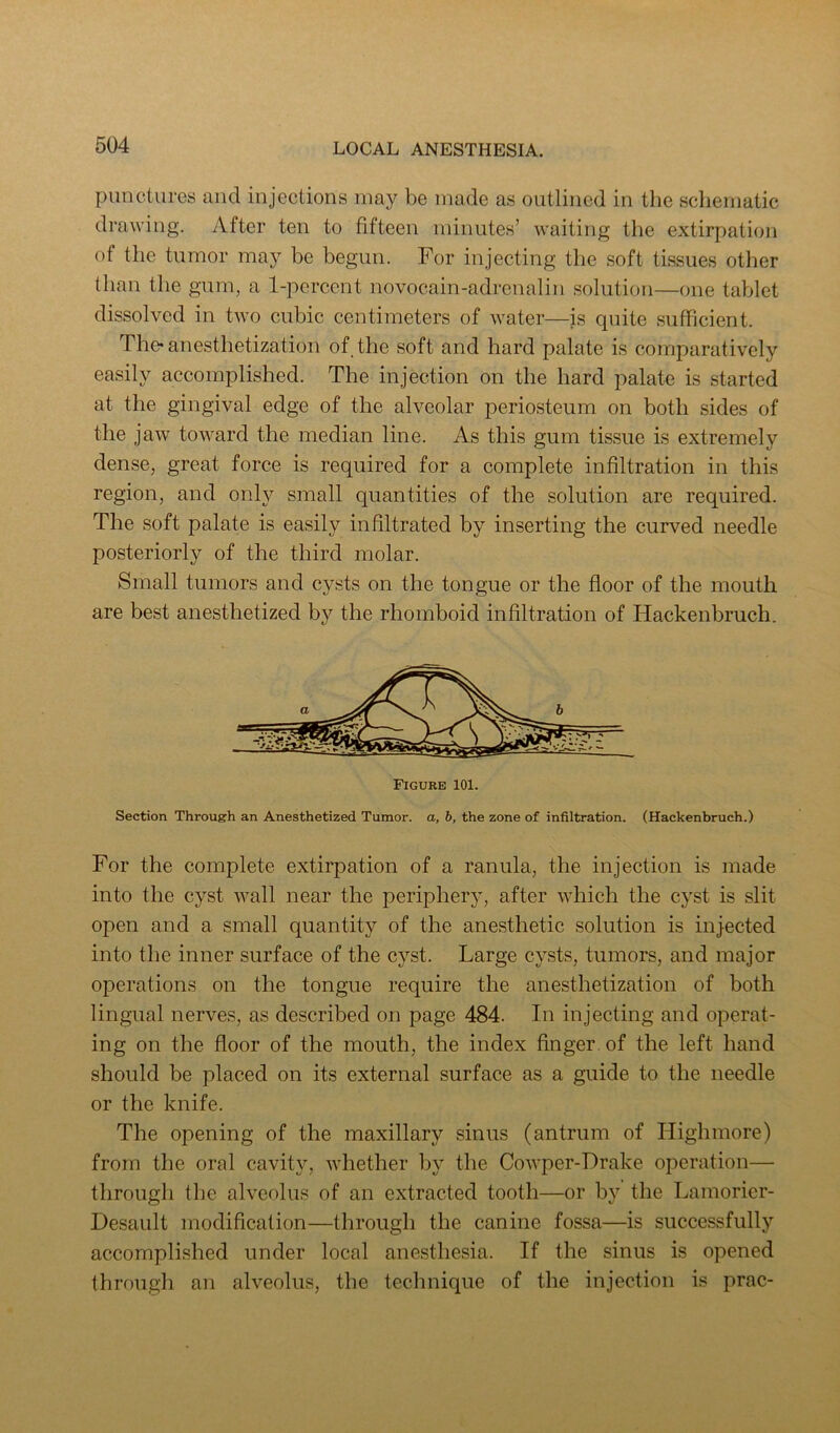 punctures and injections may be made as outlined in the schematic drawing. After ten to fifteen minutes’ waiting tlie extirpation of the tumor may be begun. For injecting the soft tissues other than the gum, a 1-percent novocain-adrenalin solution—one tablet dissolved in two cubic centimeters of water—is quite sufficient. The* anesthetization of the soft and hard palate is comparatively easily accomplished. The injection on the hard palate is started at the gingival edge of the alveolar periosteum on both sides of the jaw toward the median line. As this gum tissue is extremely dense, great force is required for a complete infiltration in this region, and only small quantities of the solution are required. The soft palate is easily infiltrated by inserting the curved needle posteriorly of the third molar. Small tumors and cysts on the tongue or the floor of the mouth are best anesthetized by the rhomboid infiltration of Hackenbruch. Section Through an Anesthetized Tumor, a, b, the zone of infiltration. (Hackenbruch.) For the complete extirpation of a ranula, the injection is made into the cyst wall near the periphery, after which the cyst is slit open and a small quantity of the anesthetic solution is injected into the inner surface of the cyst. Large cysts, tumors, and major operations on the tongue require the anesthetization of both lingual nerves, as described on page 484. In injecting and operat- ing on the floor of the mouth, the index finger of the left hand should be placed on its external surface as a guide to the needle or the knife. The opening of the maxillary sinus (antrum of Highmore) from the oral cavity, whether by the Cowper-Drake operation— through the alveolus of an extracted tooth—or by the Lamorier- Desault modification—through the canine fossa—is successfully accomplished under local anesthesia. If the sinus is opened through an alveolus, the technique of the injection is prac-