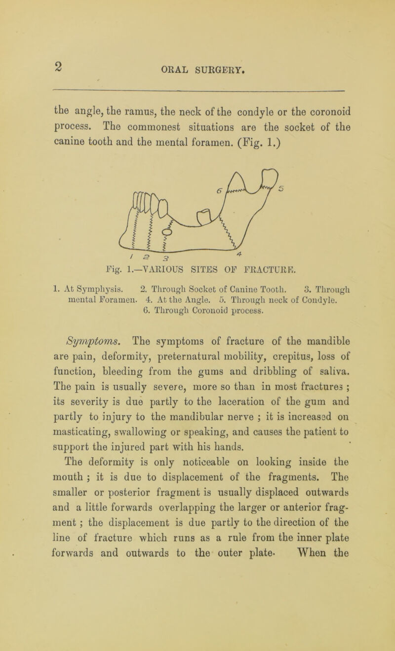 the angle, the ramus, the neck of the condyle or the coronoid process. The commonest situations are the socket of the canine tooth and the mental foramen. (Fig. 1.) Fig. 1.—VARIOUS SITES OF FRACTURE. 1. At Symphysis. 2. Through Socket of Canine Tooth. 3. Through mental Foramen. 4. At the Angle. 5. Through neck of Condyle. 6. Through Coronoid process. Symptoms. The symptoms of fracture of the mandible are pain, deformity, preternatural mobility, crepitus, loss of function, bleeding from the gums and dribbling of saliva. The pain is usually severe, more so than in most fractures ; its severity is due partly to the laceration of the gum and partly to injury to the mandibular nerve ; it is increased on masticating, swallowing or speaking, and causes the patient to support the injured part with his hands. The deformity is only noticeable on looking inside the mouth ; it is due to displacement of the fragments. The smaller or posterior fragment is usually displaced outwards and a little forwards overlapping the larger or anterior frag- ment ; the displacement is due partly to the direction of the line of fracture which runs as a rule from the inner plate forwards and outwards to the outer plate- When the