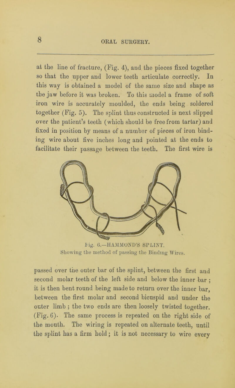 at the line of fracture, (Fig. 4), and the pieces fixed togethor so that the upper and lower teeth articulate correctly. In this way is obtained a model of the same size and shape as the jaw before it was broken. To this model a frame of soft iron wire is accurately moulded, the ends being soldered together (Fig. 5). Tho splint thus constructed is next slipped over the patient’s teeth (which should be free from tartar) and fixed in position by means of a number of pieces of iron bind- ing wire about five inches long and pointed at the ends to facilitate their passage between the teeth. The first wire is lig. 6.—HAMMOND’S SPLINT. Showing the method of passing the Binding Wires. passed over the outer bar of the splint, between the first and second molar teeth of the left side and below the inner bar ; it is then bent round being made to return over the inner bar, between the first molar and second bicuspid and under the outer limb ; the two ends are then loosely twisted together. (Fig. 6). The same process is repeated on the right side of the mouth. The wiring is repeated on alternate teeth, until the splint has a firm hold; it is not necessary to wire every