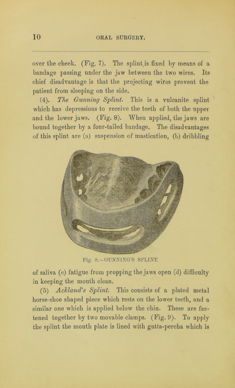 over the cheek. (Fig. 7). The splint is fixed by means of a bandage passing under the jaw between the two wires. Its chief disadvantage is that the projecting wires prevent the patient from sleeping on the side. (4). The Gunning Splint* This is a vulcanite splint which has depressions to receive the teeth of both the upper and the lower jaws. (Fig. 8). When applied, the jaws are bound together by a four-tailed bandage. The disadvantages of this splint are (a) suspension of mastication, (b) dribbling Fig. 8.—GUNNING’S SPLINT. of saliva (c) fatigue from propping the jaws open (d) difficulty in keeping the mouth clean. (5) AcJcland's Splint. This consists of a plated metal horse-shoe shaped piece which rests on the lower teeth, and a similar one which is applied below the chin. These are fas- tened together by two movable clamps. (Fig. 9). To apply the splint the mouth plate is lined with gutta-percha which is
