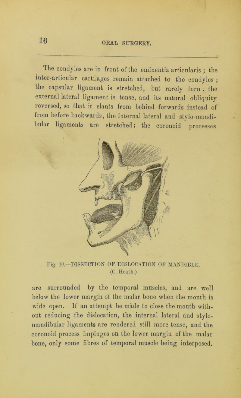 ORAL SURGERY. ihe condyles are in front of the eminentia articnlaris ; the inter-articular cartilages remain attached to the condyles ; the capsular ligament is stretched, but rarely torn , the external lateral ligament is tense, and its natural obliquity reversed, so that it slants from behind forwards instead of from before backwards, the internal lateral and stylo-mandi- bular ligaments are stretched; the coronoid processes Fig. 10.—DISSECTION OF DISLOCATION OF MANDIBLE. (C. Heath.) are surrounded by the temporal muscles, and are well below the lower margin of the malar bone when the mouth is wide open. If an attempt be made to close the mouth with- out reducing fhe dislocation, the internal lateral and stylo- mandibular ligaments are rendered still more tense, and the coronoid process impinges on the lower margin of the malar bone, only some fibres of temporal muscle being interposed.