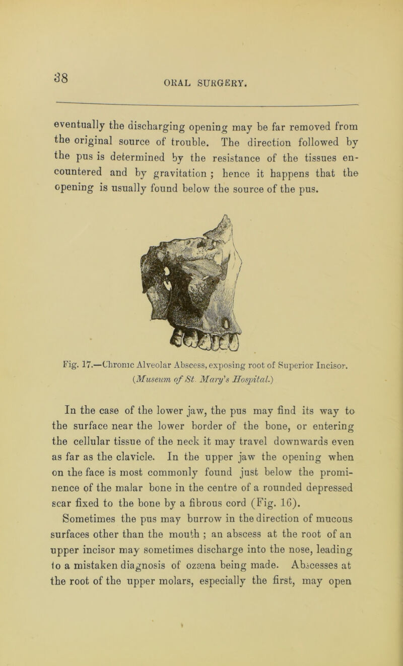 S8 ORAL SURGERY. eventually the discharging opening may be far removed from the original source of trouble. The direction followed by the pus is determined by the resistance of the tissues en- countered and by gravitation ; hence it happens that the opening is usually found below the source of the pus. Fig. 17.—Chronic Alveolar Abscess, exposing root of Superior Incisor. (.Museum of St. Mary’s Hospital.) In the case of the lower jaw, the pus may find its way to the surface near the lower border of the bone, or entering the cellular tissue of the neck it may travel downwards even as far as the clavicle. In the upper jaw the opening when on ihe face is most commonly found just below the promi- nence of the malar bone in the centre of a rounded depressed scar fixed to the bone by a fibrous cord (Fig. 16). Sometimes the pus may burrow in the direction of mucous surfaces other than the mouth ; an abscess at the root of an upper incisor may sometimes discharge into the nose, leading 1o a mistaken diagnosis of ozaena being made. Abscesses at the root of the upper molars, especially the first, may open