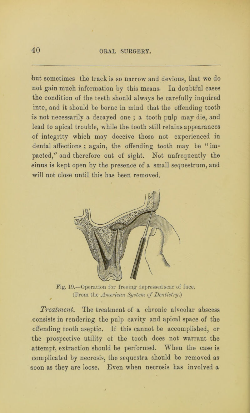 but sometimes the track is so narrow and devious, that we do not gain much information by this means. In doubtful cases the condition of the teeth should always be carefully inquired into, and it should be borne in mind that the offending tooth is not necessarily a decayed one ; a tooth pulp may die, and lead to apical trouble, while the tooth still retains appearances of integrity which may deceive those not experienced in dental affections ; again, the offending tooth may be “ im- pacted,” and therefore out of sight. Not unfrequently the sinus is kept open by the presence of a small sequestrum, and will not close until this has been removed. Fig. 19.—Operation for freeing depressed scar of face. (From the American System of Dentistry.) Treatment. The treatment of a chronic alveolar abscess consists in rendering the pulp cavity and apical space of the offending tooth aseptic. If this cannot be accomplished, or the prospective utility of the tooth does not warrant the attempt, extraction should be performed. When the case is complicated by necrosis, the sequestra should be removed as soon as they are loose. Even when necrosis has involved a