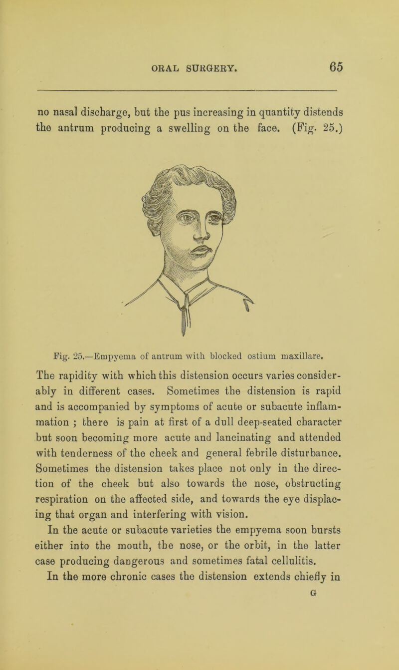 no nasal discharge, but the pus increasing in quantity distends the antrum producing a swelling on the face. (Fig. 25.) Fig. 25.—Empyema of antrum with blocked ostium maxillare. The rapidity with which this distension occurs varies consider- ably in different cases. Sometimes the distension is rapid and is accompanied by symptoms of acute or subacute inflam- mation ; there is pain at first of a dull deep-seated character but soon becoming more acute and lancinating and attended with tenderness of the cheek and general febrile disturbance. Sometimes the distension takes place not only in the direc- tion of the cheek but also towards the nose, obstructing respiration on the affected side, and towards the eye displac- ing that organ and interfering with vision. In the acute or subacute varieties the empyema soon bursts either into the mouth, the nose, or the orbit, in the latter case producing dangerous and sometimes fatal cellulitis. In the more chronic cases the distension extends chiefly in G