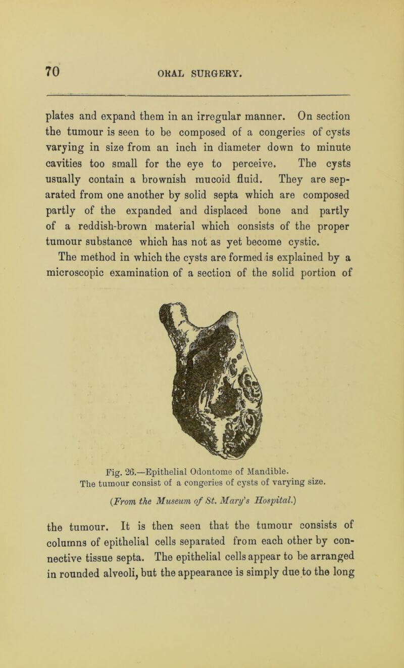 plates and expand them in an irregular manner. On section the tumour is seen to be composed of a congeries of cysts varying in size from an inch in diameter down to minute cavities too small for the eye to perceive. The cysts usually contain a brownish mucoid fluid. They are sep- arated from one another by solid septa which are composed partly of the expanded and displaced bone and partly of a reddish-brown material which consists of the proper tumour substance which has not as yet become cystic. The method in which the cysts are formed is explained by a microscopic examination of a section of the solid portion of Fig. 26.—Epithelial Odontome of Mandible. The tumour consist of a congeries of cysts of varying size. {From the Museum of St. Mary's Hospital.) the tumour. It is then seen that the tumour consists of columns of epithelial cells separated from each other by con- nective tissue septa. The epithelial cells appear to be arranged in rounded alveoli, but the appearance is simply due to the long