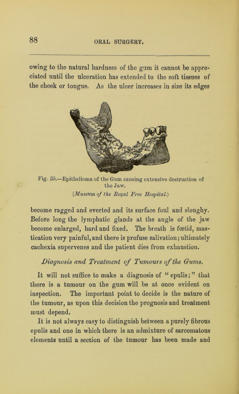 owing to the natural hardness of the gum it cannot be appre- ciated until the ulceration has extended to the soft tissues of the cheek or tongue. As the ulcer increases in size its edges Fig. 35.—Epithelioma of the Gum causing extensive destruction of the Jaw. (.Museum of the Royal Free Hospital.) become ragged and everted and its surface foul and sloughy. Before long the lymphatic glands at the angle of the jaw become enlarged, hard and fixed. The breath is foetid, mas- tication very painful,and there is profuse salivation;ultimately cachexia supervenes and the patient dies from exhaustion. Diagnosis and Treatment of Tumours of the Gums. It will not suffice to make a diagnosis of “epulis;” that there is a tumour on the gum will be at once evident on inspection. The important point to decide is the nature of the tumour, as upon this decision the prognosis and treatment must depend. It is not always easy to distinguish between a purely fibrous epulis and one in which there is an admixture of sarcomatous elements until a section of the tumour has been made and