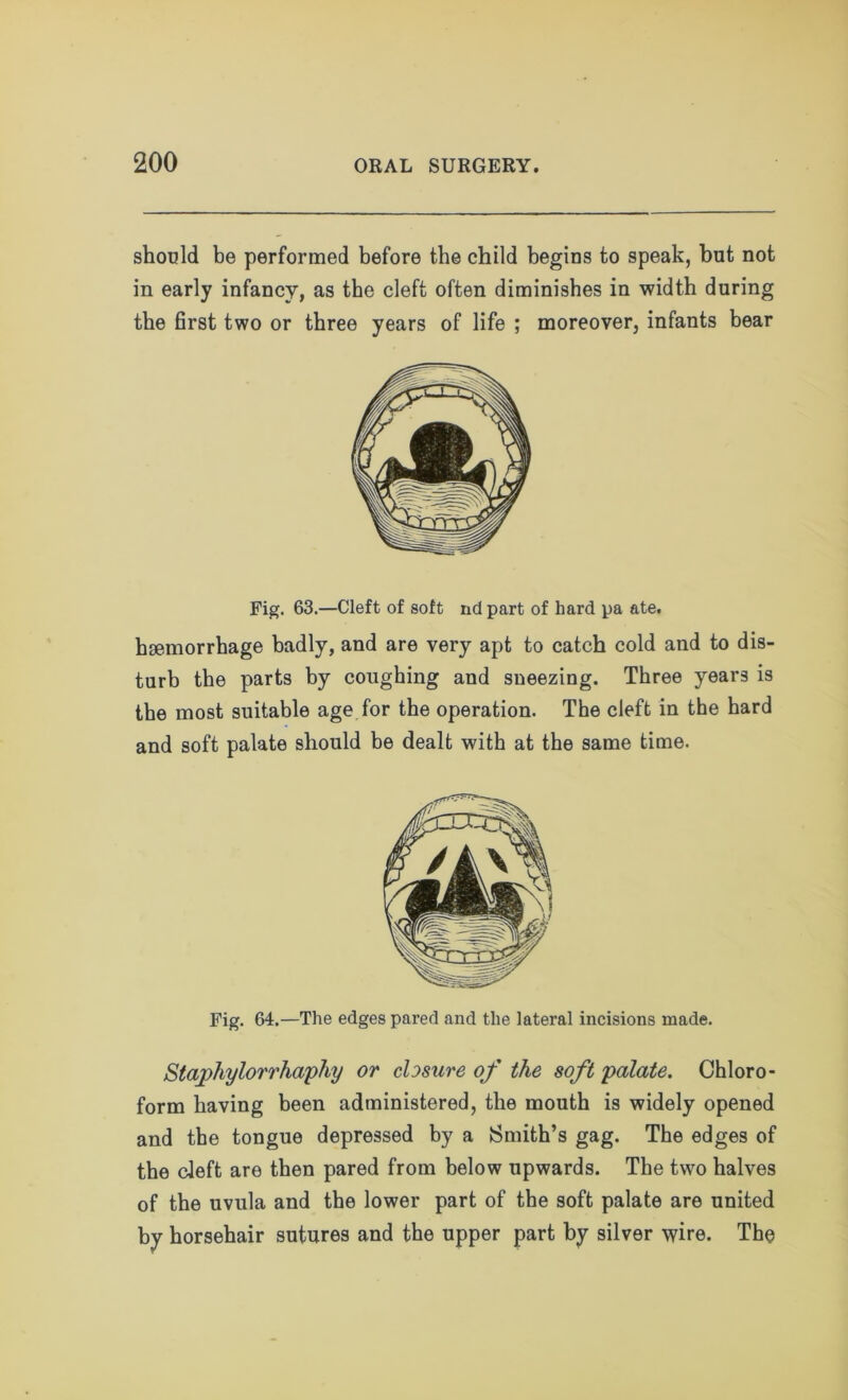 should be performed before the child begins to speak, but not in early infancy, as the cleft often diminishes in width during the first two or three years of life ; moreover, infants bear Fig. 63.—Cleft of soft nd part of hard pa ate. haemorrhage badly, and are very apt to catch cold and to dis- turb the parts by coughing and sneezing. Three years is the most suitable age for the operation. The cleft in the hard and soft palate should be dealt with at the same time. Fig. 64.—The edges pared and the lateral incisions made. Staphylorrhaphy or closure of the soft palate. Chloro- form having been administered, the mouth is widely opened and the tongue depressed by a Smith’s gag. The edges of the cleft are then pared from below upwards. The two halves of the uvula and the lower part of the soft palate are united by horsehair sutures and the upper part by silver wire. The