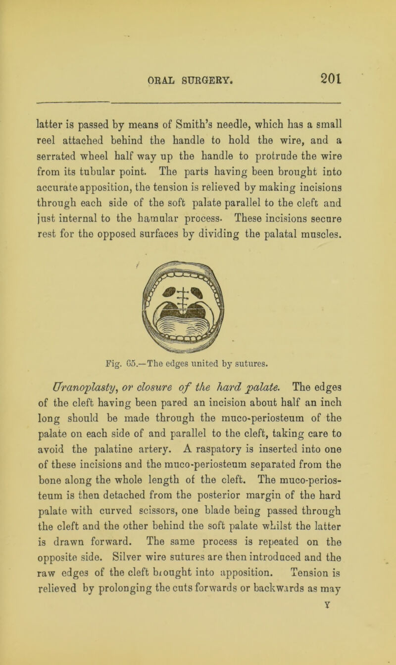 latter is passed by means of Smith’s needle, which has a small reel attached behind the handle to hold the wire, and a serrated wheel half way up the handle to protrude the wire from its tubular point. The parts having been brought into accurate apposition, the tension is relieved by making incisions through each side of the soft palate parallel to the cleft and just internal to the hamular process- These incisions secnre rest for the opposed surfaces by dividing the palatal muscles. Fig. Go.—The edges united by sutures. Uranoplasty, or closure of the hard palate. The edges of the cleft having been pared an incision about half an inch long should be made through the muco-periosteum of the palate on each side of and parallel to the cleft, taking care to avoid the palatine artery. A raspatory is inserted into one of these incisions and the muco-periosteum separated from the bone along the whole length of the cleft. The muco-perios- teum is then detached from the posterior margin of the hard palate with curved scissors, one blade being passed through the cleft and the other behind the soft palate whilst the latter is drawn forward. The same process is repeated on the opposite side. Silver wire sutures are then introdoced and the raw edges of the cleft hi ought into apposition. Tension is relieved by prolonging the cuts forwards or backwards as may y