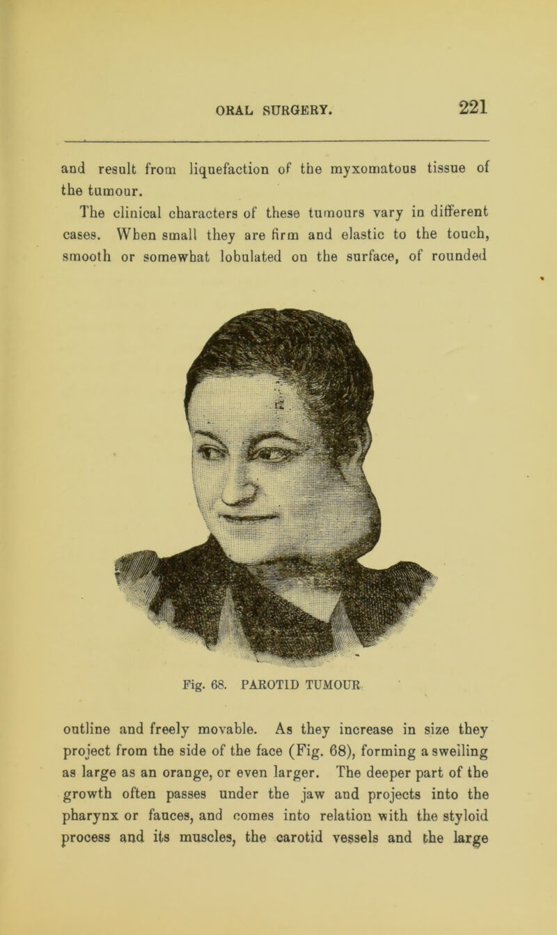 and result from liquefaction of the myxomatous tissue of the tumour. The clinical characters of these tumours vary in different cases. When small they are firm and elastic to the touch, smooth or somewhat lobulated on the surface, of rounded Fig. 68. PAROTID TUMOUR outline and freely movable. As they increase in size they project from the side of the face (Fig. 68), forming a swelling as large as an orange, or even larger. The deeper part of the growth often passes under the jaw and projects into the pharynx or fauces, and comes into relation with the styloid process and its muscles, the carotid vessels and the large