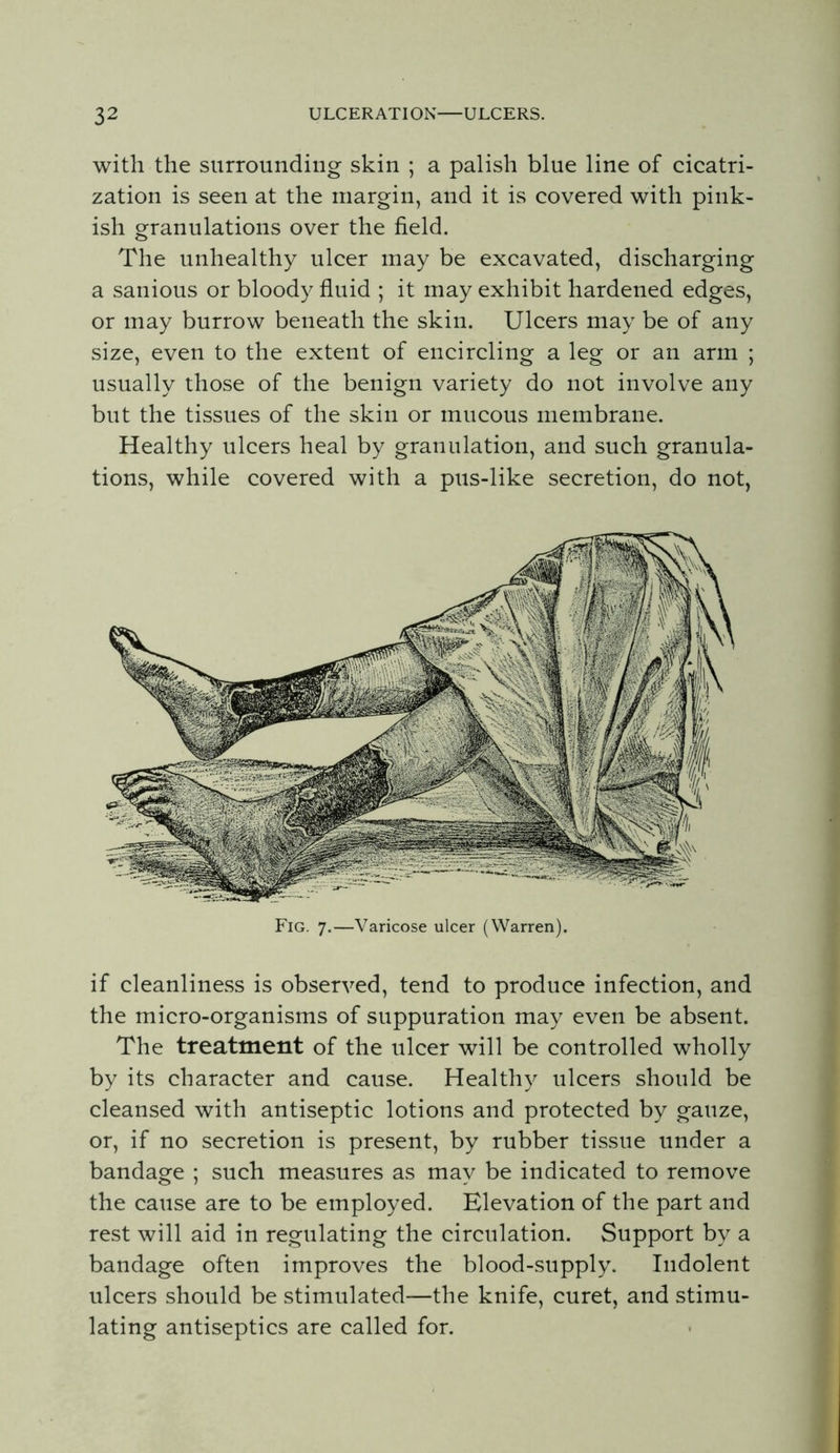 with the surrounding skin ; a palish blue line of cicatri- zation is seen at the margin, and it is covered with pink- ish granulations over the field. The unhealthy ulcer may be excavated, discharging a sanious or bloody fluid ; it may exhibit hardened edges, or may burrow beneath the skin. Ulcers may be of any size, even to the extent of encircling a leg or an arm ; usually those of the benign variety do not involve any but the tissues of the skin or mucous membrane. Healthy ulcers heal by granulation, and such granula- tions, while covered with a pus-like secretion, do not, Fig. 7.—Varicose ulcer (Warren). if cleanliness is observed, tend to produce infection, and the micro-organisms of suppuration may even be absent. The treatment of the ulcer will be controlled wholly by its character and cause. Healthy ulcers should be cleansed with antiseptic lotions and protected by gauze, or, if no secretion is present, by rubber tissue under a bandage ; such measures as may be indicated to remove the cause are to be employed. Elevation of the part and rest will aid in regulating the circulation. Support by a bandage often improves the blood-supply. Indolent ulcers should be stimulated—the knife, curet, and stimu- lating antiseptics are called for.