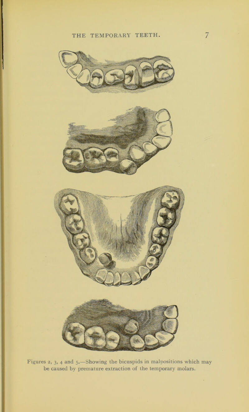Figures 2, 3, 4 and 5.—Showing the bicuspids in malpositions which may be caused by premature extraction of the temporary molars.