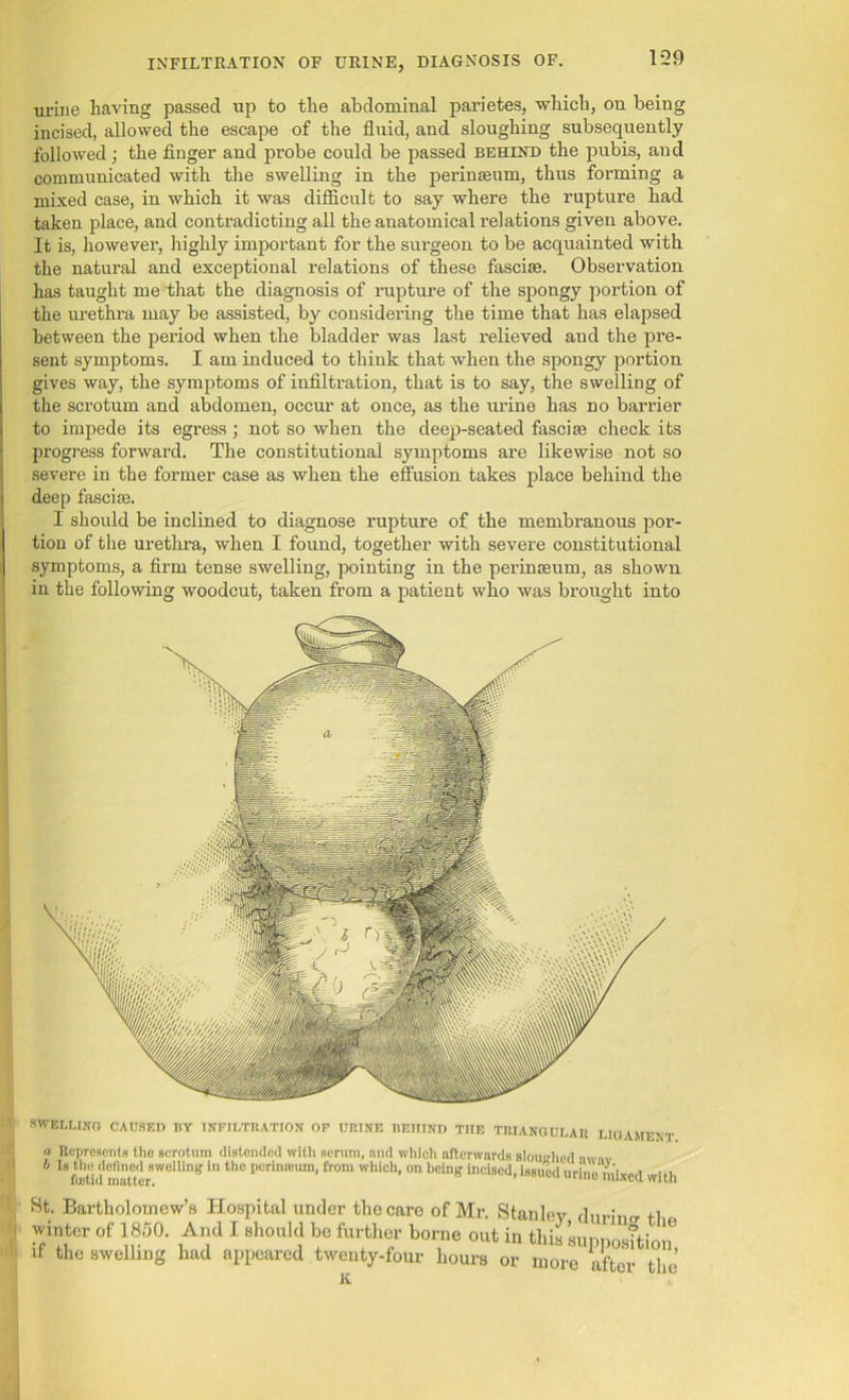 1-29 urine having passed up to the abdominal parietes, which, on being incised, allowed the escape of the fluid, and sloughing subsequently followed; the finger and probe could be passed behind the pubis, and communicated with the swelling in the perinseum, thus forming a mixed case, in which it was difficult to say where the rupture had taken place, and contradicting all the anatomical relations given above. It is, however, highly important for the surgeon to be acquainted with the natural and exceptional relations of these fasciae. Observation has taught me that the diagnosis of rupture of the spongy portion of the urethra may be assisted, by considering the time that has elapsed between the period when the bladder was last relieved and the pre- sent symptoms. I am induced to think that when the spongy portion gives way, the symptoms of infiltration, that is to say, the swelling of the scrotum and abdomen, occur at once, as the urine has no barrier to impede its egress; not so when the deep-seated fasciae check its progress forward. The constitutional symptoms are likewise not so severe in the former case as when the effusion takes place behind the deep fasciae. I should be inclined to diagnose rupture of the membranous por- tion of the urethra, when I found, together with severe constitutional symptoms, a firm tense swelling, pointing in the perinaeum, as shown in the following woodcut, taken from a patient who was brought into swelling caused by infiltration of urine behind the triangular ligament « Represents the scrotum distended with serum, and which afterwards slouched awnv 4 1%fflUd matter WdUng thC pcrinteum’ froru which> on bein& incised, issued urine mixed with St. Bartholomew’s Hospital under the care of Mr. Stanlev. rWl™ K.