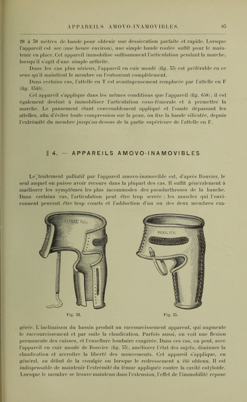 A P PAREIL S AMOVO-IN AMOVIBLE S. 95 20 à 50 mètres de bande pour obtenir une dessiccation parfaite et rapide. Lorsque l'appareil est sec (une heure environ), une simple bande roulée suffit pour le main- tenir en place. Cet appareil immobilise suffisamment l'articulation pendant la marche, lorsqu’il s’agit d’une simple arthrite. Dans les cas plus sérieux, l’appareil en cuir moulé (fig. 55) est préférable en ce sens qu’il maintient le membre en l’entourant complètement. Dans certains cas, l'attelle en T est avantageusement remplacée par l'attelle en F (fig. 1540). Cet appareil s’applique dans les mêmes conditions que l’appareil (fig. 658); il est également destiné à immobiliser l’articulation coxo-fémorale et à permettre la marche. Le pansement étant convenablement appliqué et l'ouate dépassant les attelles, afin d’éviter toute compression sur la peau, on fixe la bande silicatée, depuis l’extrémité du membre jusqu’au-dessus de la partie supérieure de l'attelle en F. §4. — APPAREILS AMOVO-I NAMOVIBLES Le’traitement palliatif par l'appareil amovo-inamovible est, d’après Bouvier, le seul auquel on puisse avoir recours dans la plupart des cas. 11 suffit généralement à améliorer les symptômes les plus incommodes des pseudarthroses de la hanche. Dans certains cas, l’articulation peut être trop serrée : les muscles qui 1 envi- ronnent peuvent être trop courts et l'adduction d’un ou des deux membres exa- gérée. L’inclinaison du bassin produit un raccourcissement apparent, qui augmente le raccourcissement et par suite la claudication. Parfois aussi, on voit une flexion permanente des cuisses, et l’ensellure lombaire exagérée. Dans ces cas, on peut, avec l’appareil en cuir moulé de Bouvier (fig. 55), améliorer l’état des sujets, diminuer la claudication et accroître la liberté des mouvements. Cet appareil s’applique, en général, au début de la coxalgie ou lorsque le redressement a été obtenu. Il est indispensable de maintenir l’extrémité du fémur appliquée contre la cavité cotyloïde. Lorsque le membre se trouve maintenu dans l’extension, l'effet de l'immobilité repose