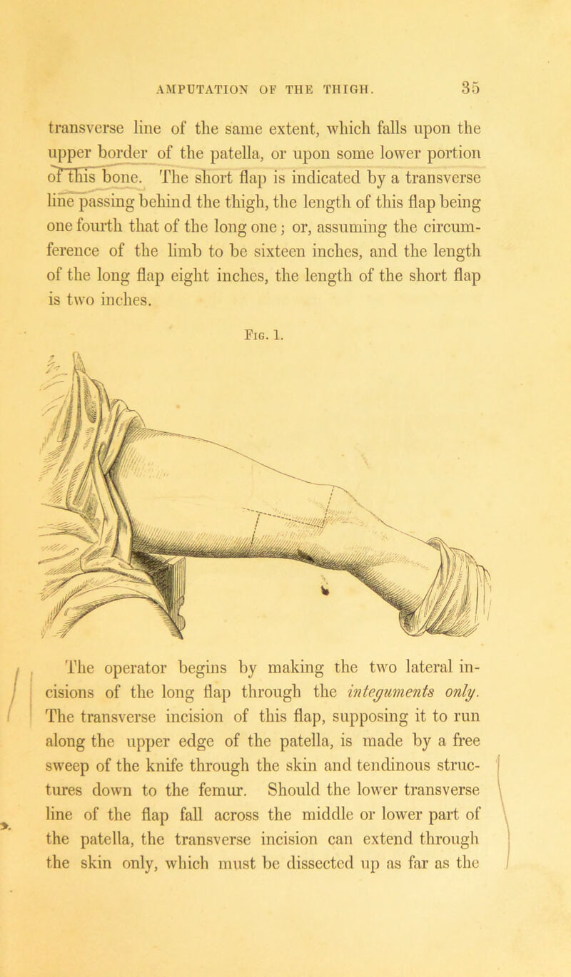 transverse line of the same extent, which falls upon the upper border of the patella, or upon some lower portion oFthis bone. The short flap is indicated by a transverse line passing behind the thigh, the length of this flap being one fourth that of the long one; or, assuming the circum- ference of the limb to be sixteen inches, and the length of the long flap eight inches, the length of the short flap is two inches. The operator begins by making the two lateral in- cisions of the long flap through the integuments only. The transverse incision of this flap, supposing it to run along the upper edge of the patella, is made by a free sweep of the knife through the skin and tendinous struc- tures down to the femur. Should the lower transverse line of the flap fall across the middle or lower part of the patella, the transverse incision can extend through the skin only, which must be dissected up as far as the