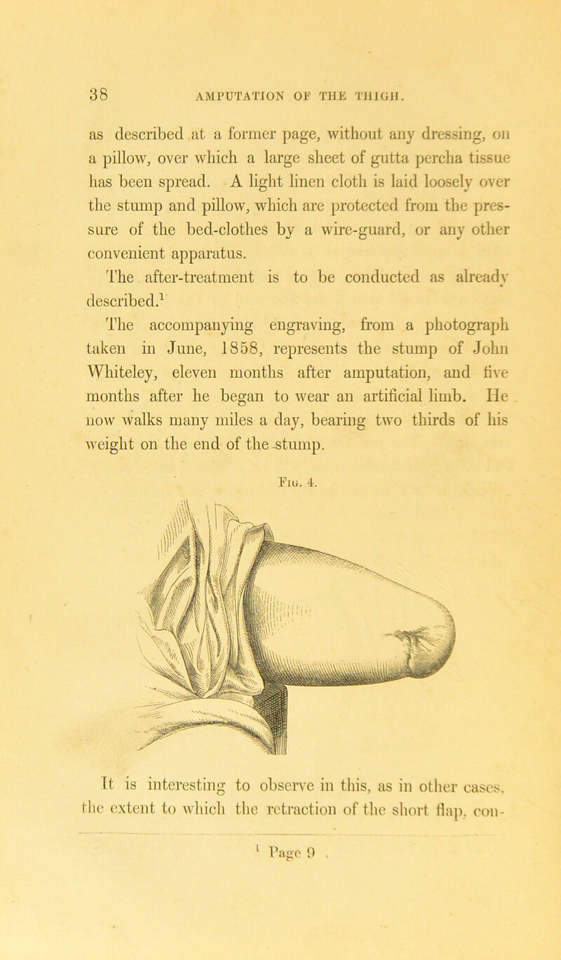 as described at a former page, without any dressing, on a pillow, over which a large sheet of gutta percha tissue has been spread. A light linen cloth is laid loosely over the stump and pillow, which are protected from the pres- sure of the bed-clothes by a wire-guard, or any other convenient apparatus. The after-treatment is to be conducted as already described.1 The accompanying engraving, from a photograph taken in June, 1858, represents the stump of John Whiteley, eleven months after amputation, and live months after he began to wear an artificial limb. He now walks many miles a day, bearing two thirds of his weight on the end of the .stump. Puj. 4. It is interesting to observe in this, as in other cases, the extent to which the retraction of the short flap, con- 1 Page 0 .