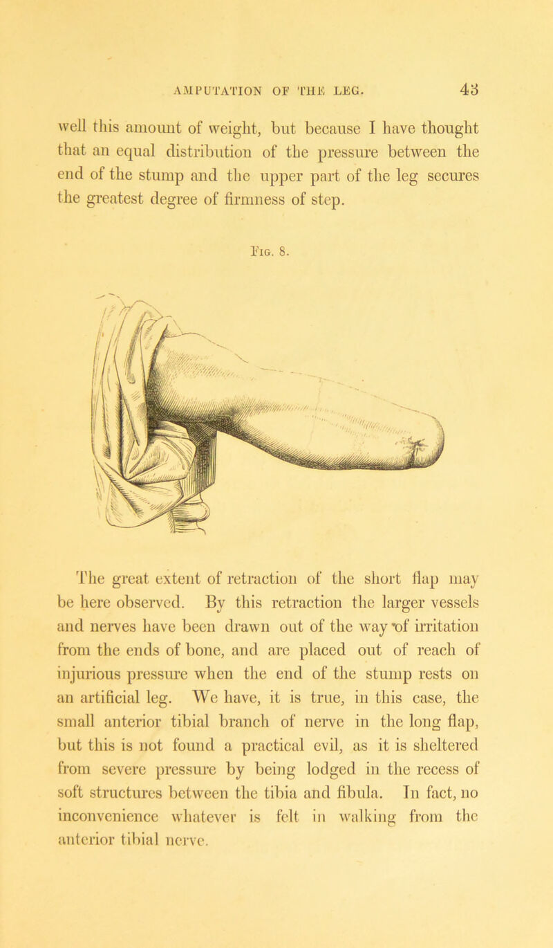 well this amount of weight, but because I have thought that an equal distribution of the pressure between the end of the stump and the upper part of the leg secures the greatest degree of firmness of step. Pig. 8. The great extent of retraction of the short flap may be here observed. By this retraction the larger vessels and nerves have been drawn out of the way 'of irritation from the ends of bone, and are placed out of reach of injurious pressure when the end of the stump rests on an artificial leg. We have, it is true, in this case, the small anterior tibial branch of nerve in the long flap, but this is not found a practical evil, as it is sheltered from severe pressure by being lodged in the recess of soft structures between the tibia and fibula. In fact, no inconvenience whatever is felt in walking from the anterior tibial nerve.