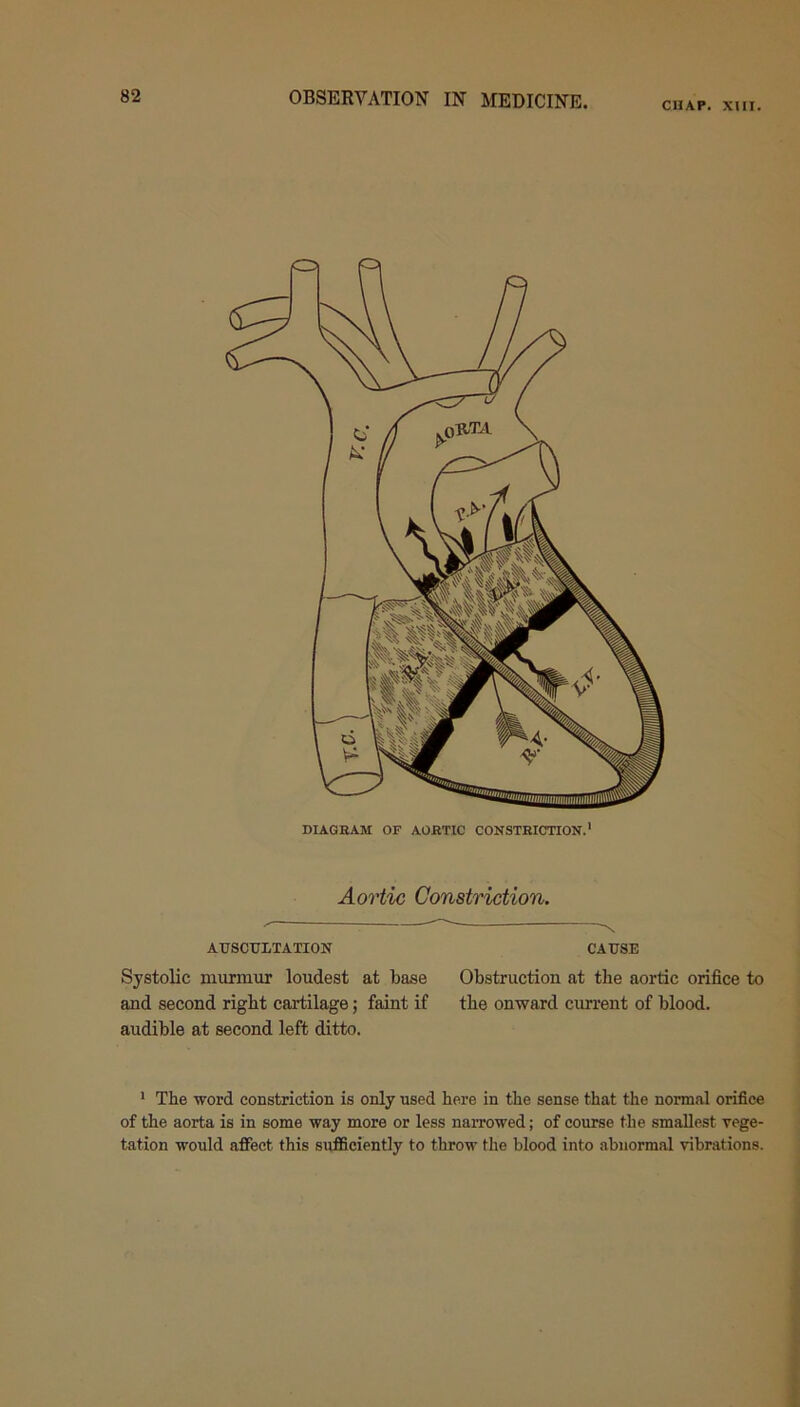 chap. xiit. DIAGRAM OF AORTIC CONSTRICTION.1 Aortic Constriction. AUSCULTATION Systolic murmur loudest at base and second right cartilage; faint if audible at second left ditto. CAUSE Obstruction at the aortic orifice to the onward current of blood. 1 The word constriction is only used here in the sense that the normal orifice of the aorta is in some way more or less narrowed; of course the smallest vege- tation would affect this sufficiently to throw the blood into abnormal vibrations.