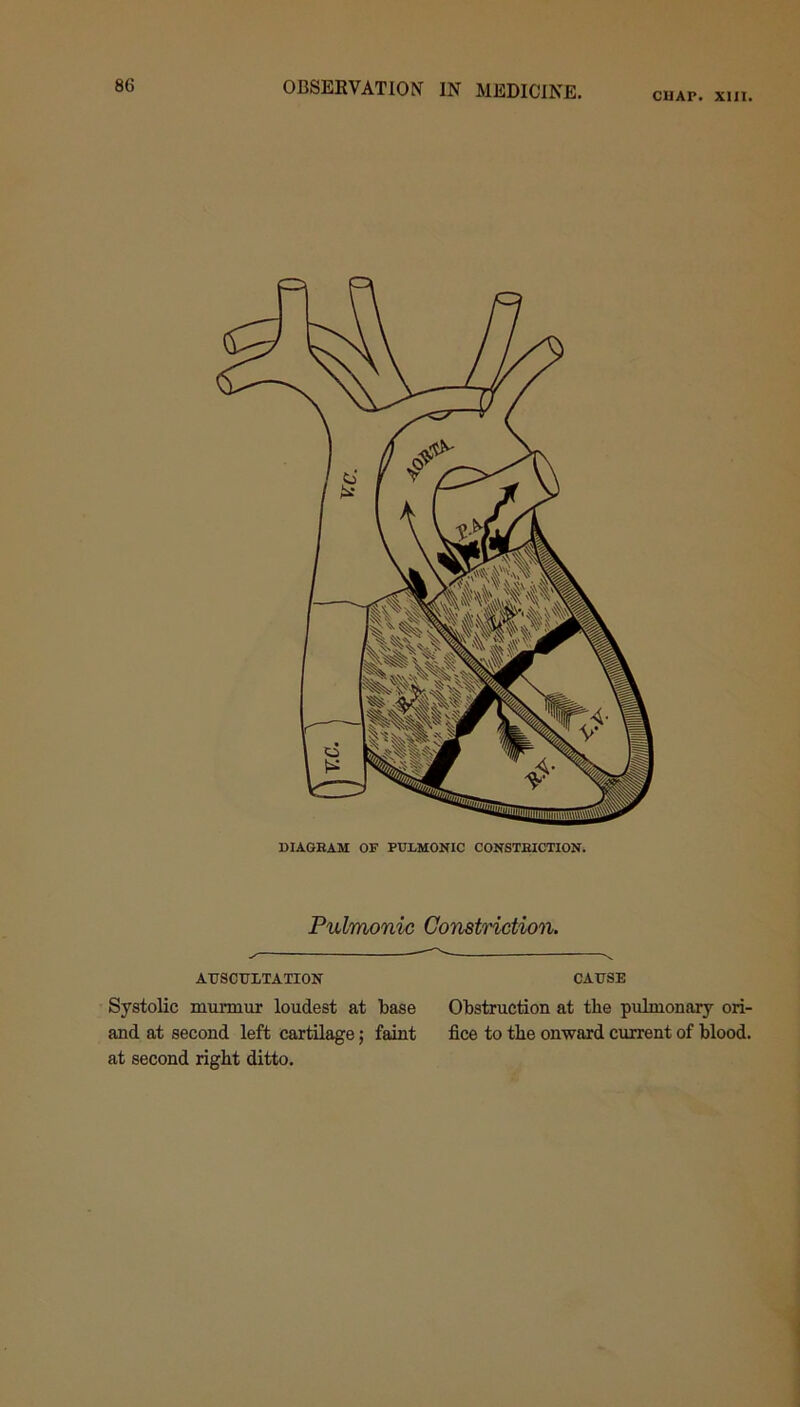 CHAP. XIII. DIAGEAM OF PULMONIC CONSTEICTION. Pulmonic Constriction. AUSCULTATION CAUSE Systolic murmur loudest at base Obstruction at tbe pulmonary ori- and at second left cartilage; faint fice to tbe onward current of blood, at second right ditto.