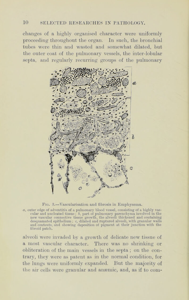 changes of a highly organised character were uniformly proceeding throughout the organ. In such, the bronchial tubes were thin and wasted and somewhat dilated, but the outer coat of the pulmonary vessels, the inter-lobular septa, and regularly recurring groups of the pulmonary Fig. 8.—Vascularisation and fibrosis in Emphysema. a, outer edge of adventitia of a pulmonary blood vessel, consisting of a highly vas- cular and nucleated tissue ; b, part of pulmonary parenchyma involved in the new vascular connective tissue growth, the alveoli thickened and containing desquamated epithelium ; c, dilated and ruptured alveoli, with granular walls and contents, and showing deposition of pigment at their junction with the fibroid patch. alveoli were invaded by a growth of delicate new tissue of a most vascular character. There was no shrinking or obliteration of the main vessels in the septa ; on the con- trary, they were as patent as in the normal condition, for the lungs were uniformly expanded. But the majority of the air cells were granular and amende, and, as if to com-